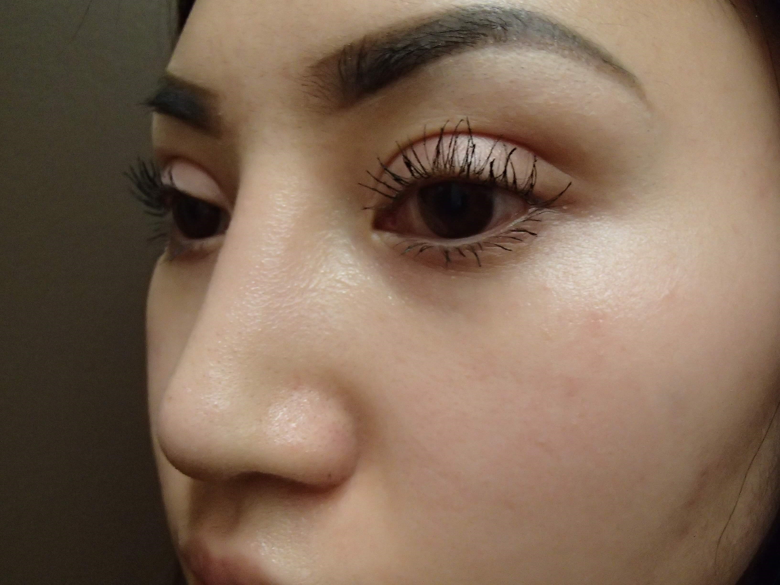 Blepharoplasty After