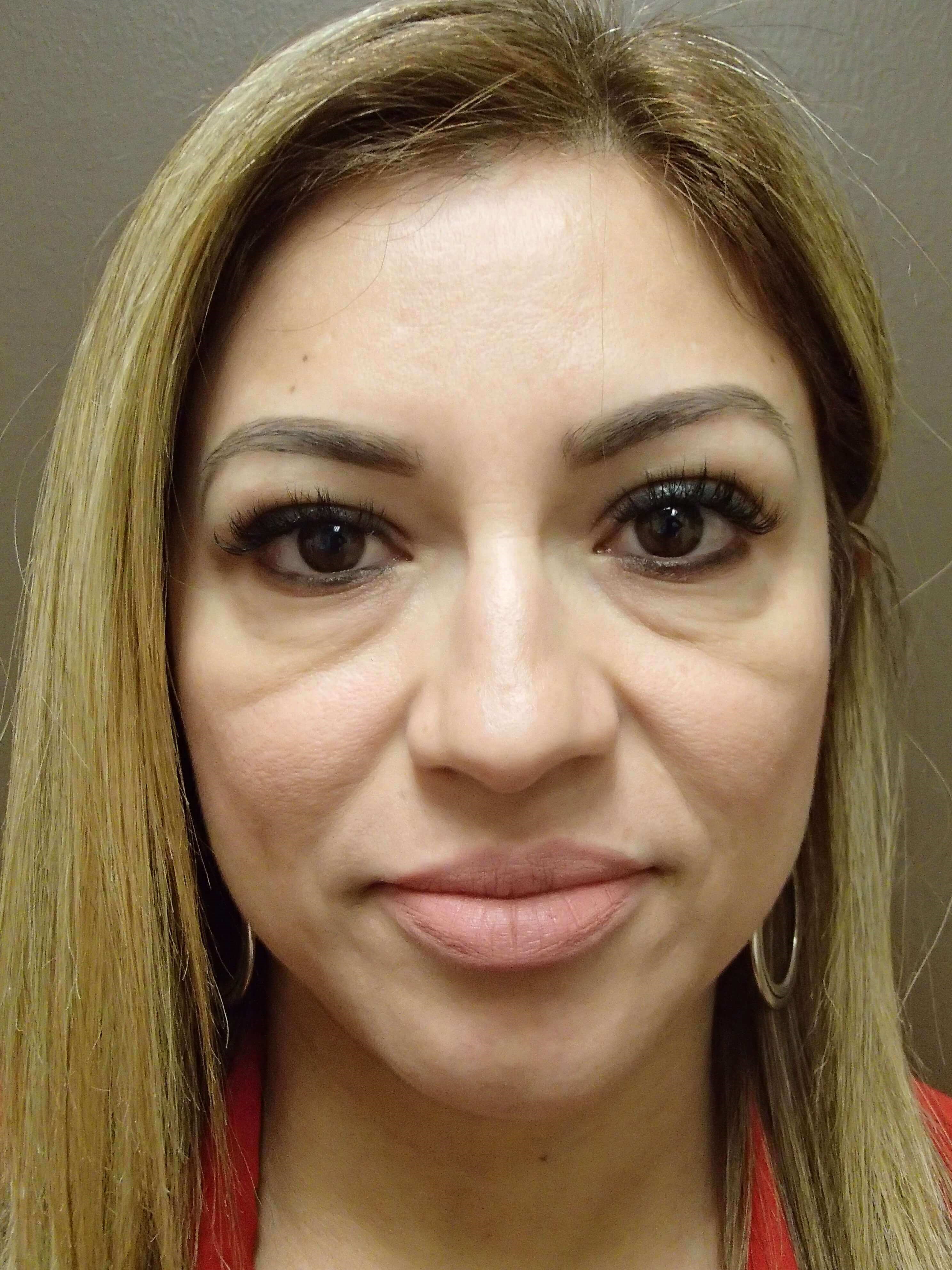 Blepharoplasty Before