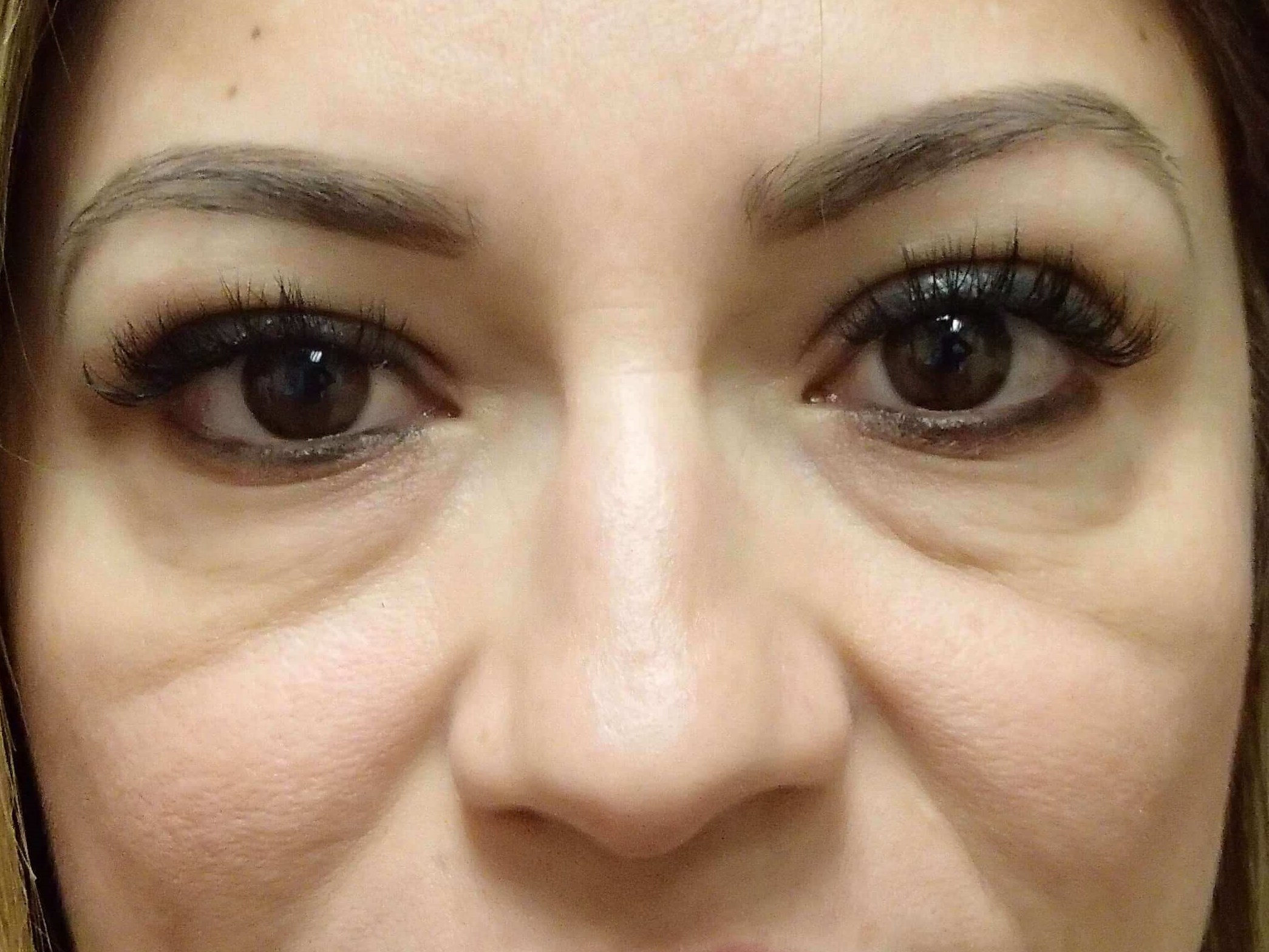 Blepharoplasty Before