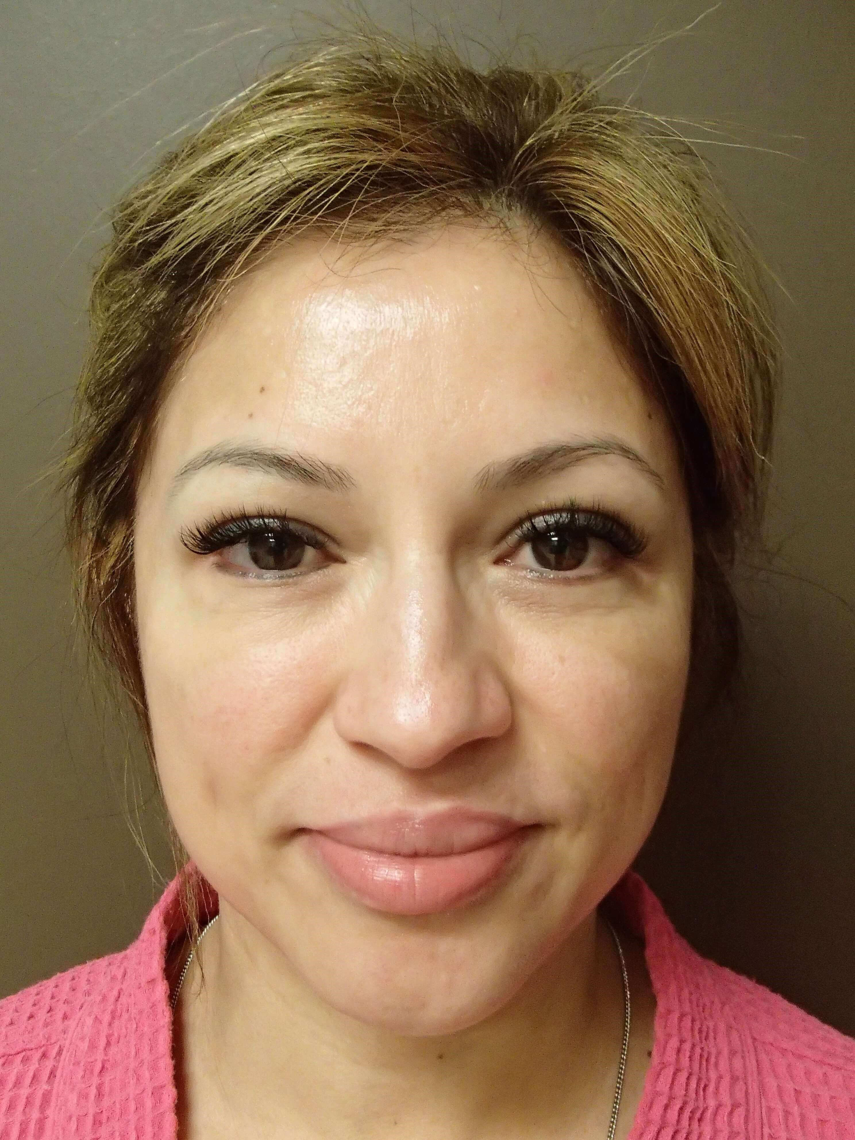 Blepharoplasty After