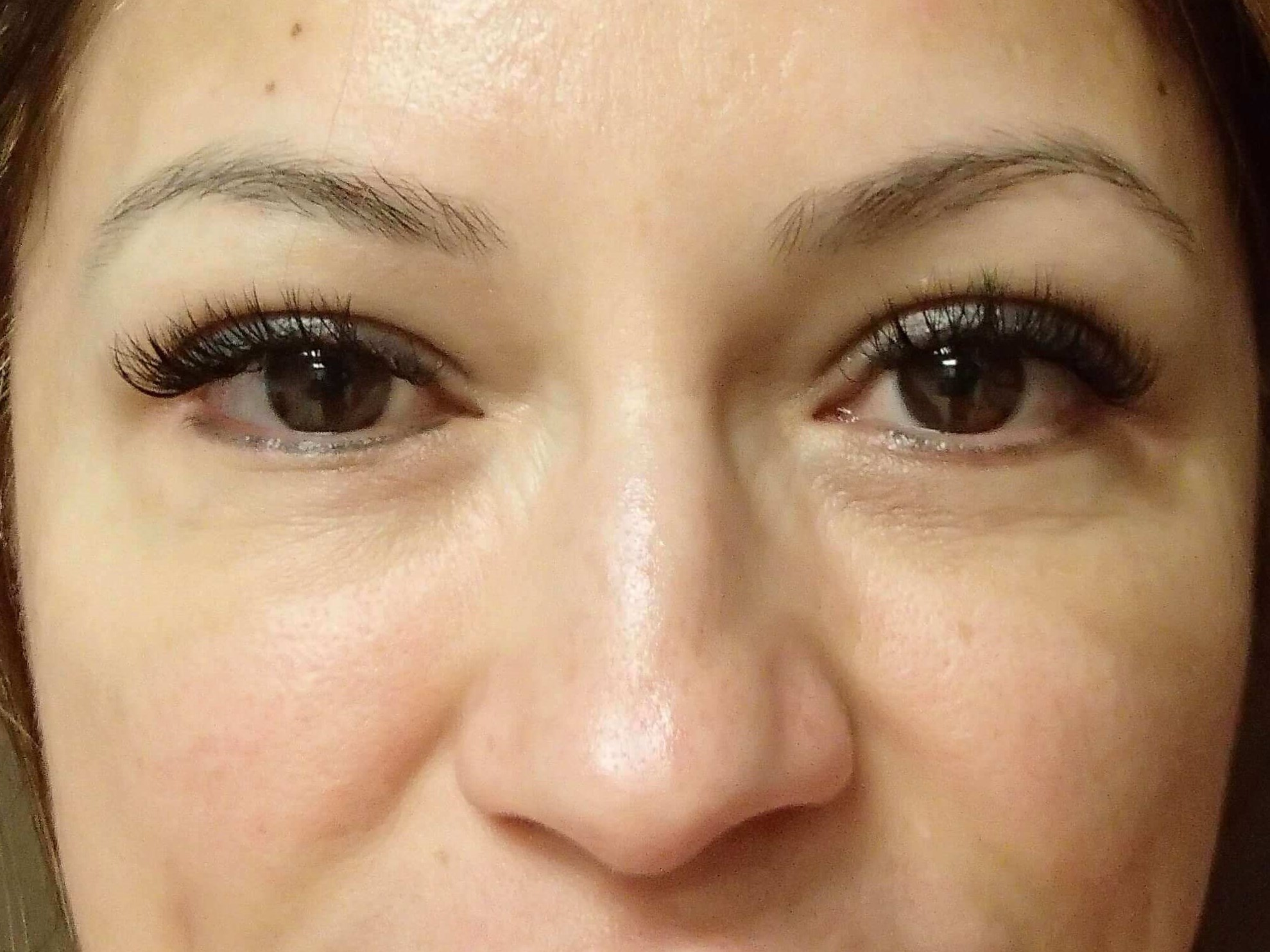 Blepharoplasty After