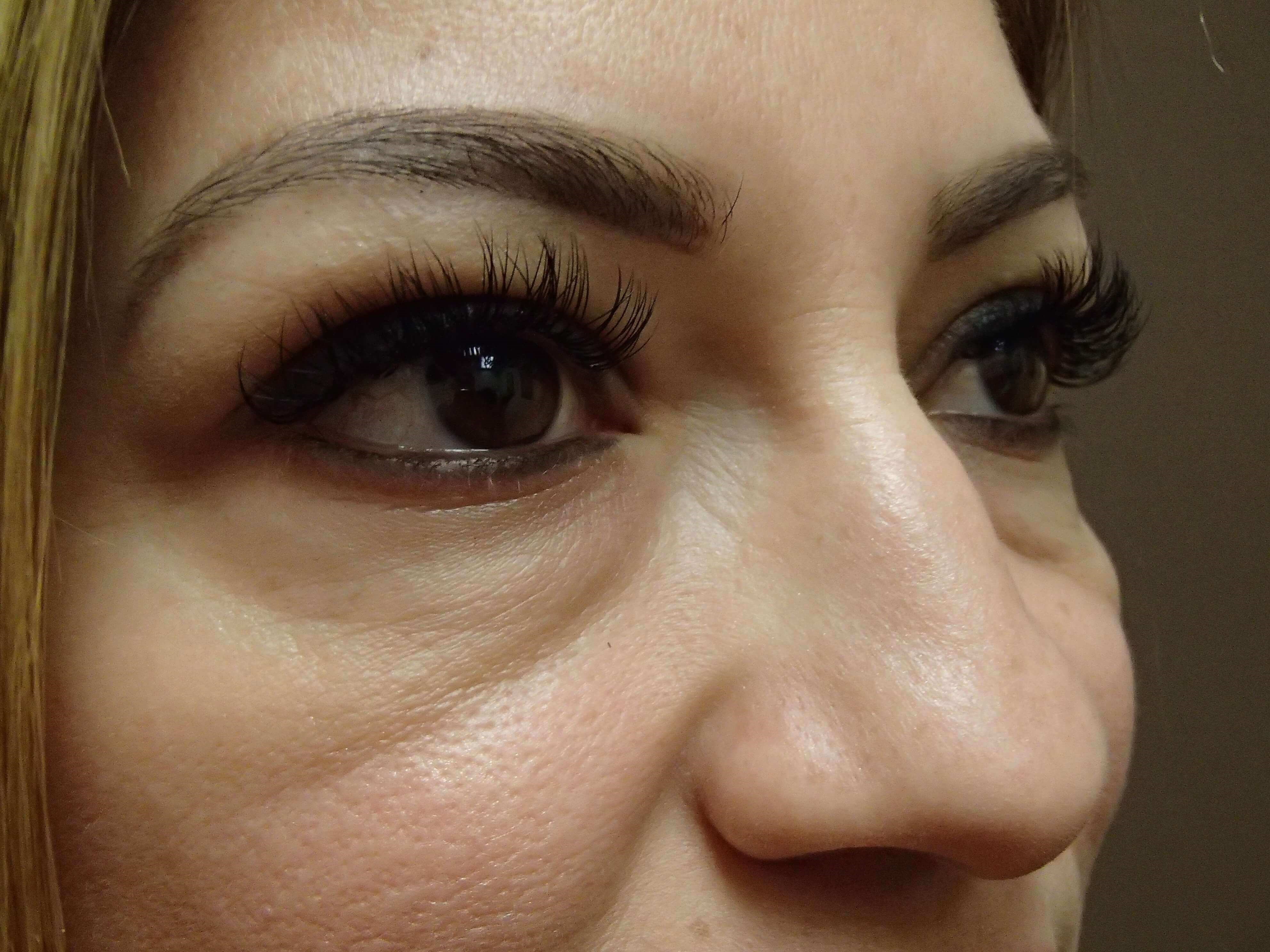 Blepharoplasty Before