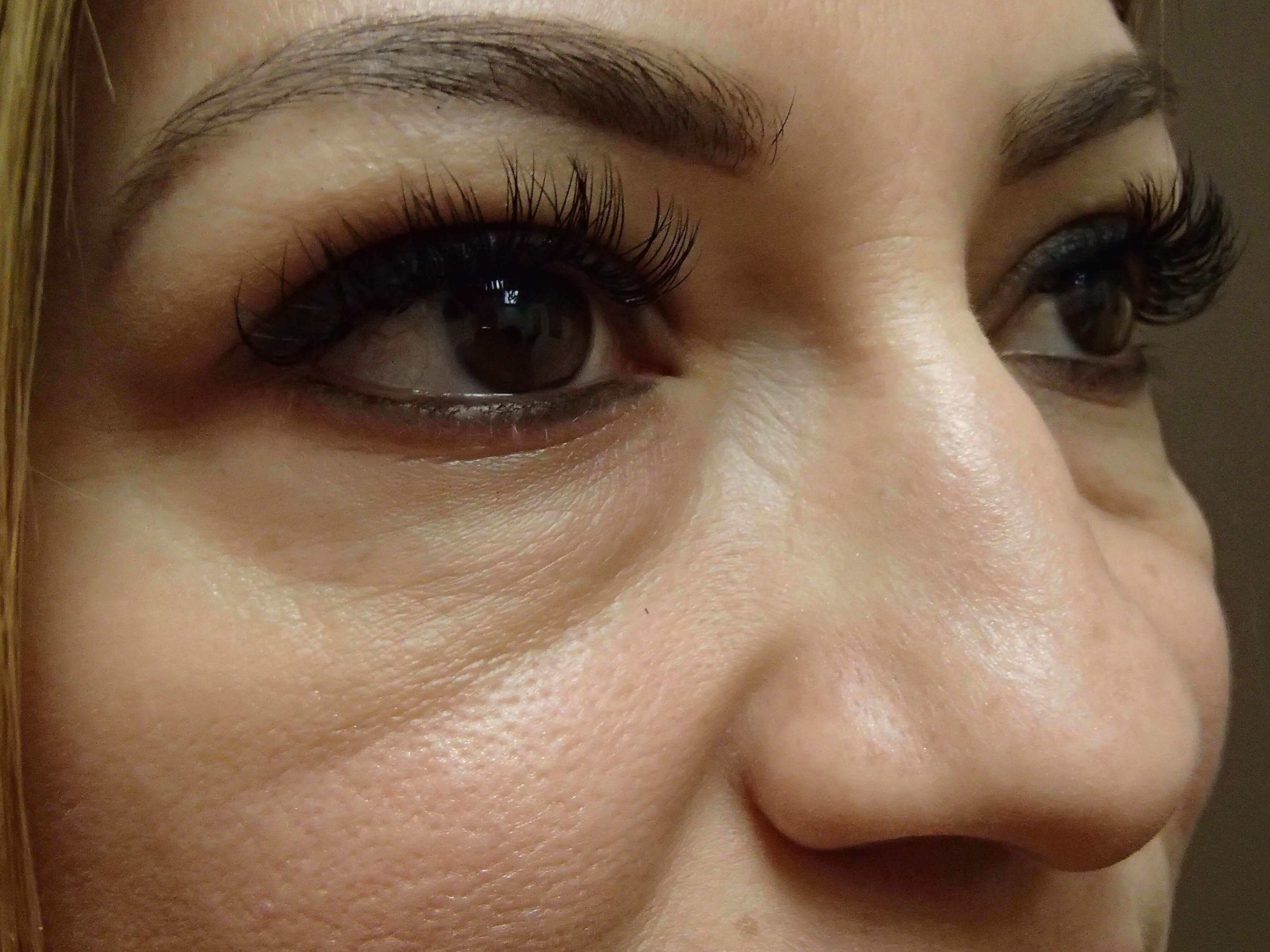 Blepharoplasty Before
