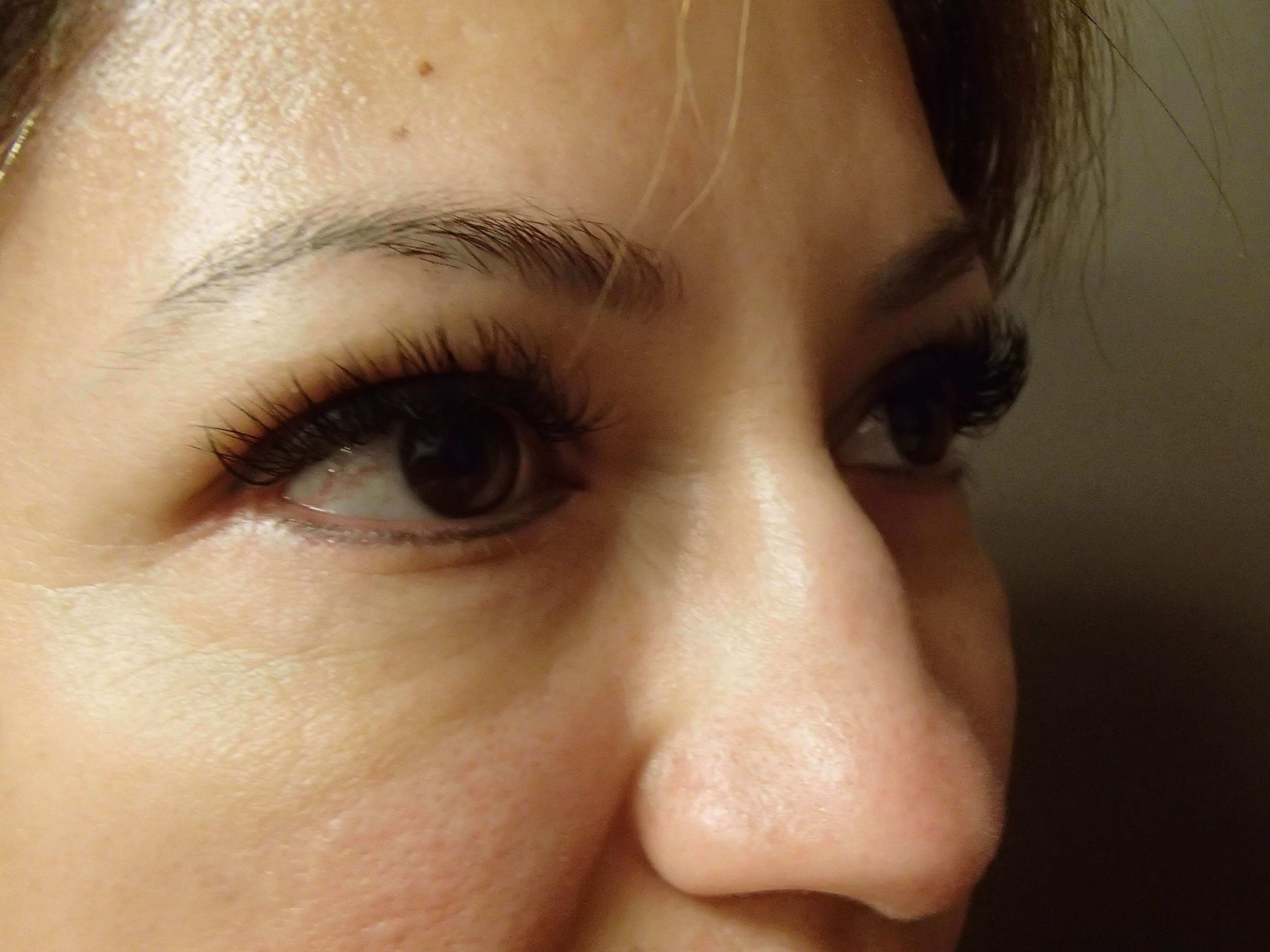 Blepharoplasty After