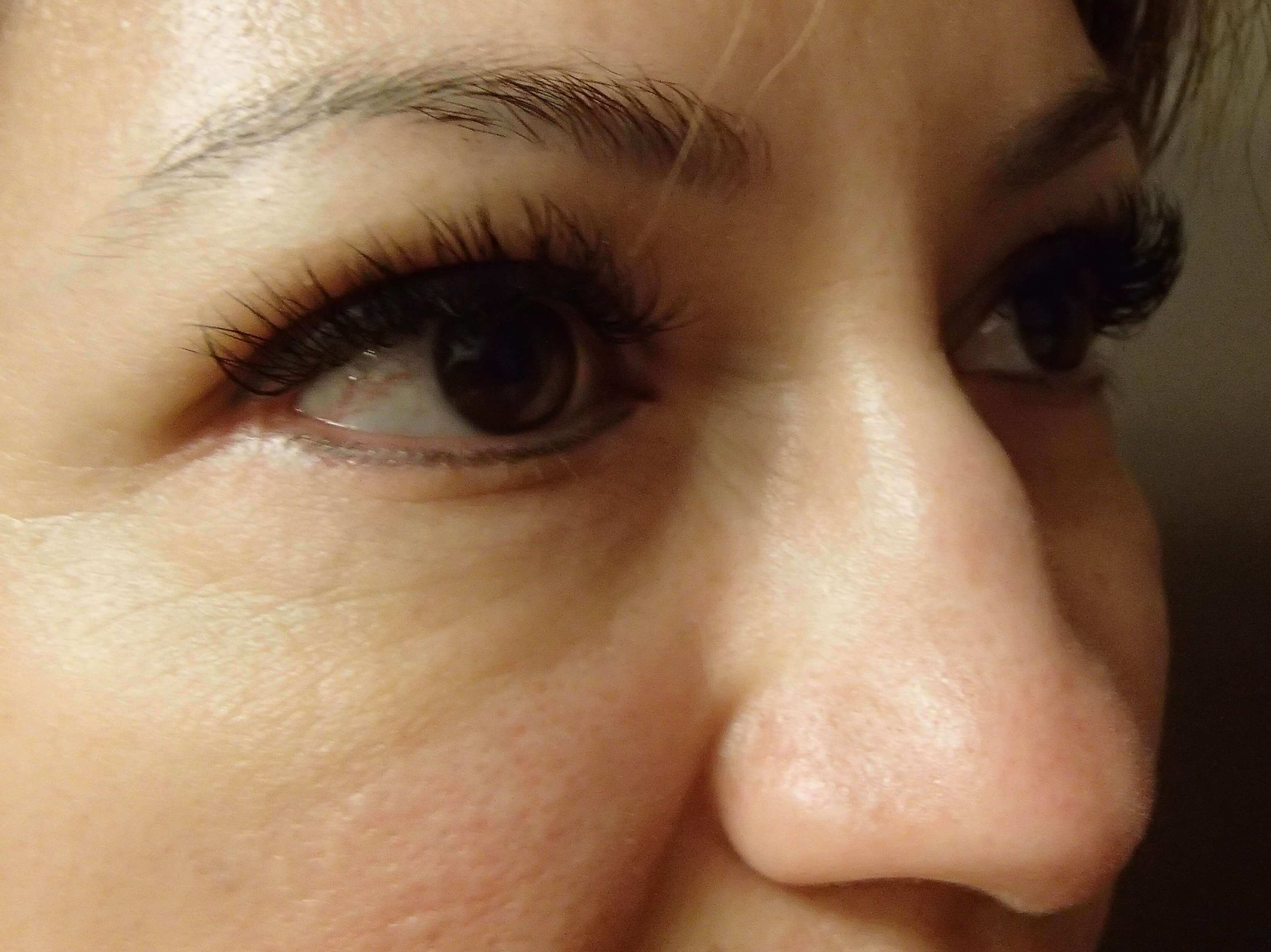 Blepharoplasty After