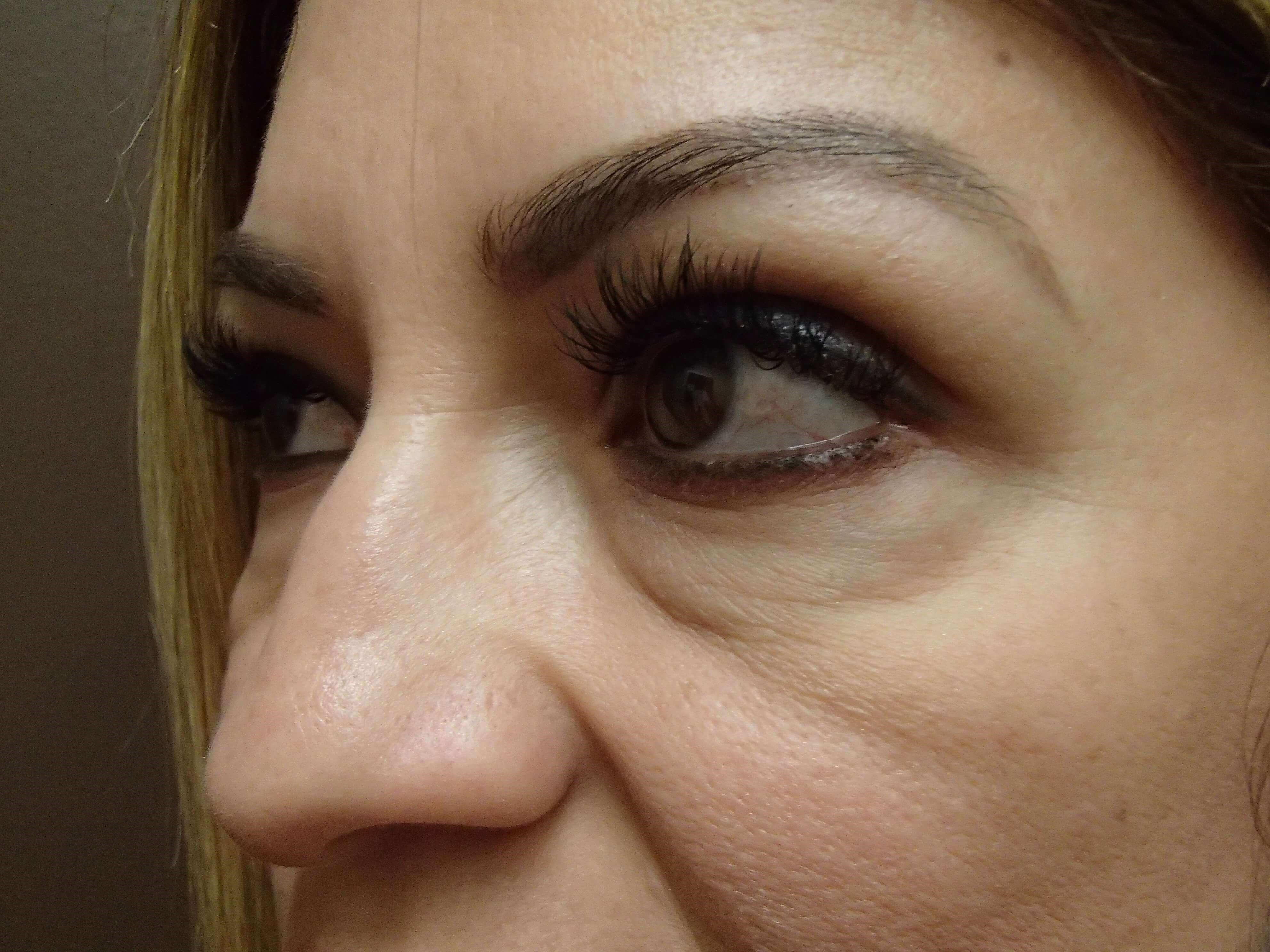 Blepharoplasty Before