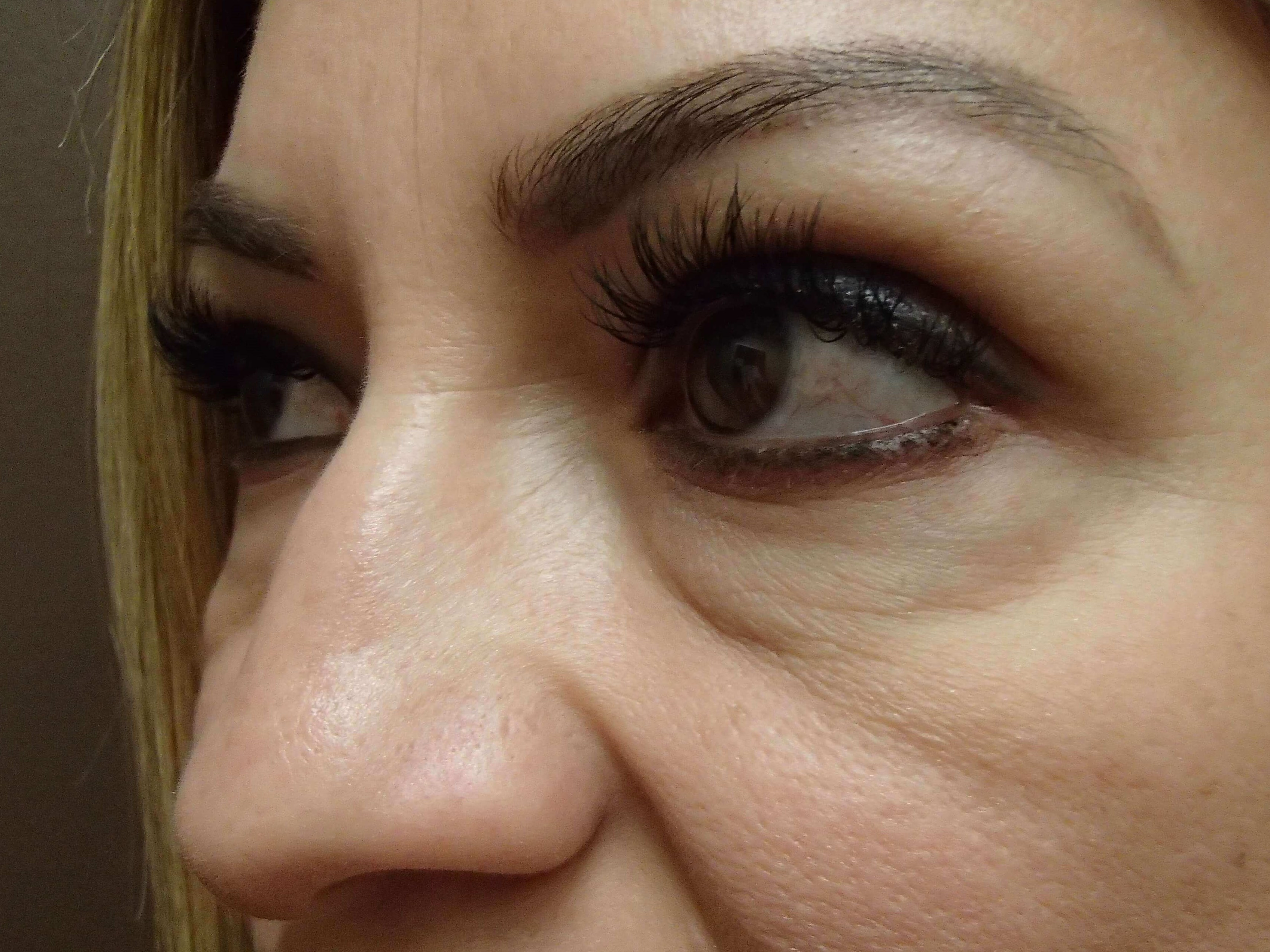 Blepharoplasty Before