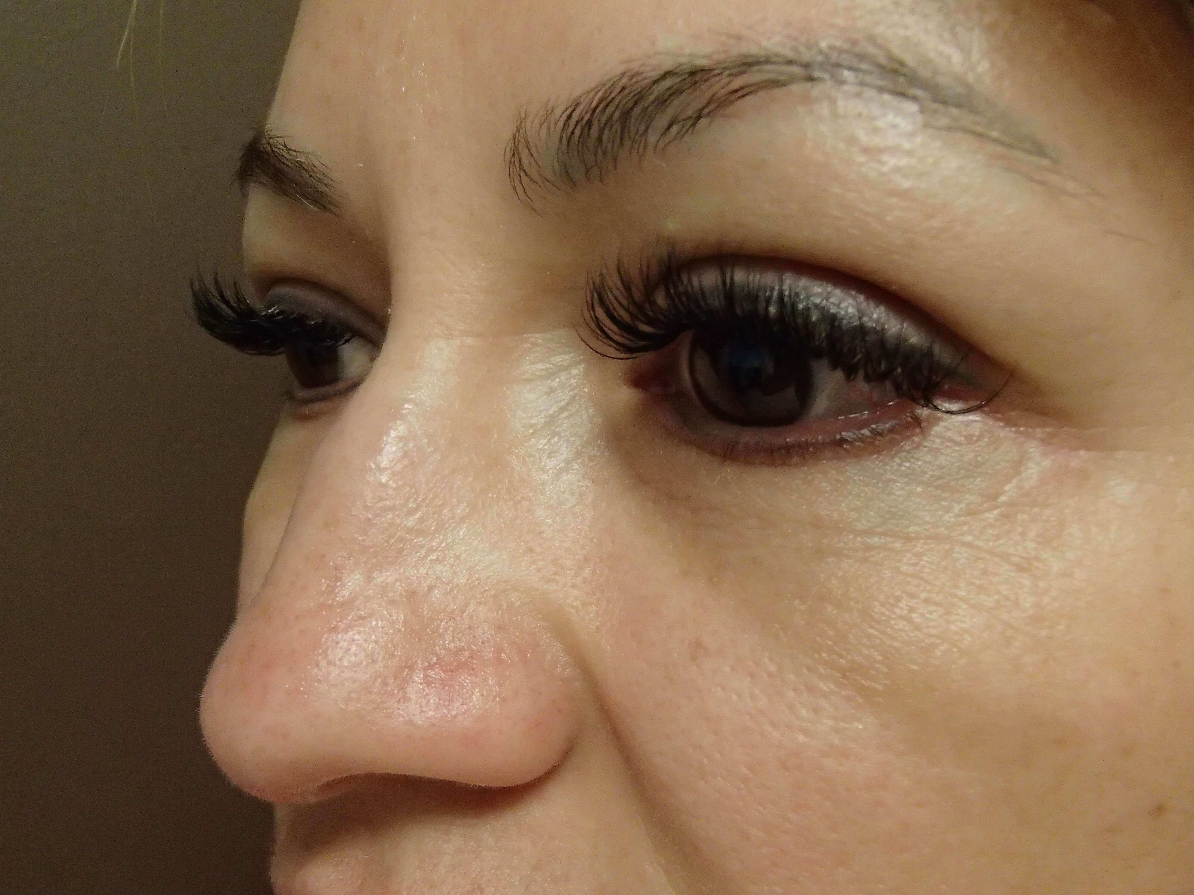 Blepharoplasty After