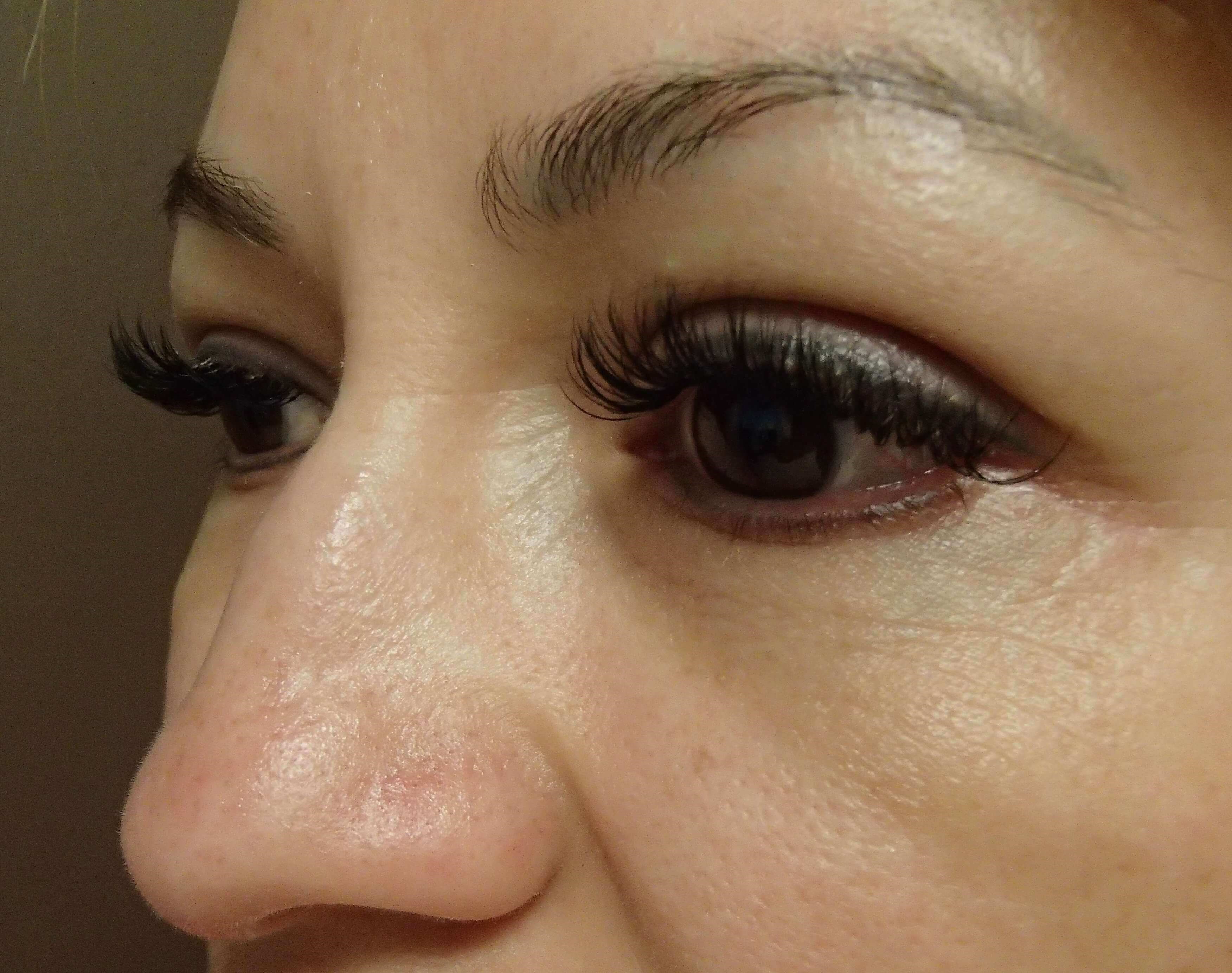 Blepharoplasty After