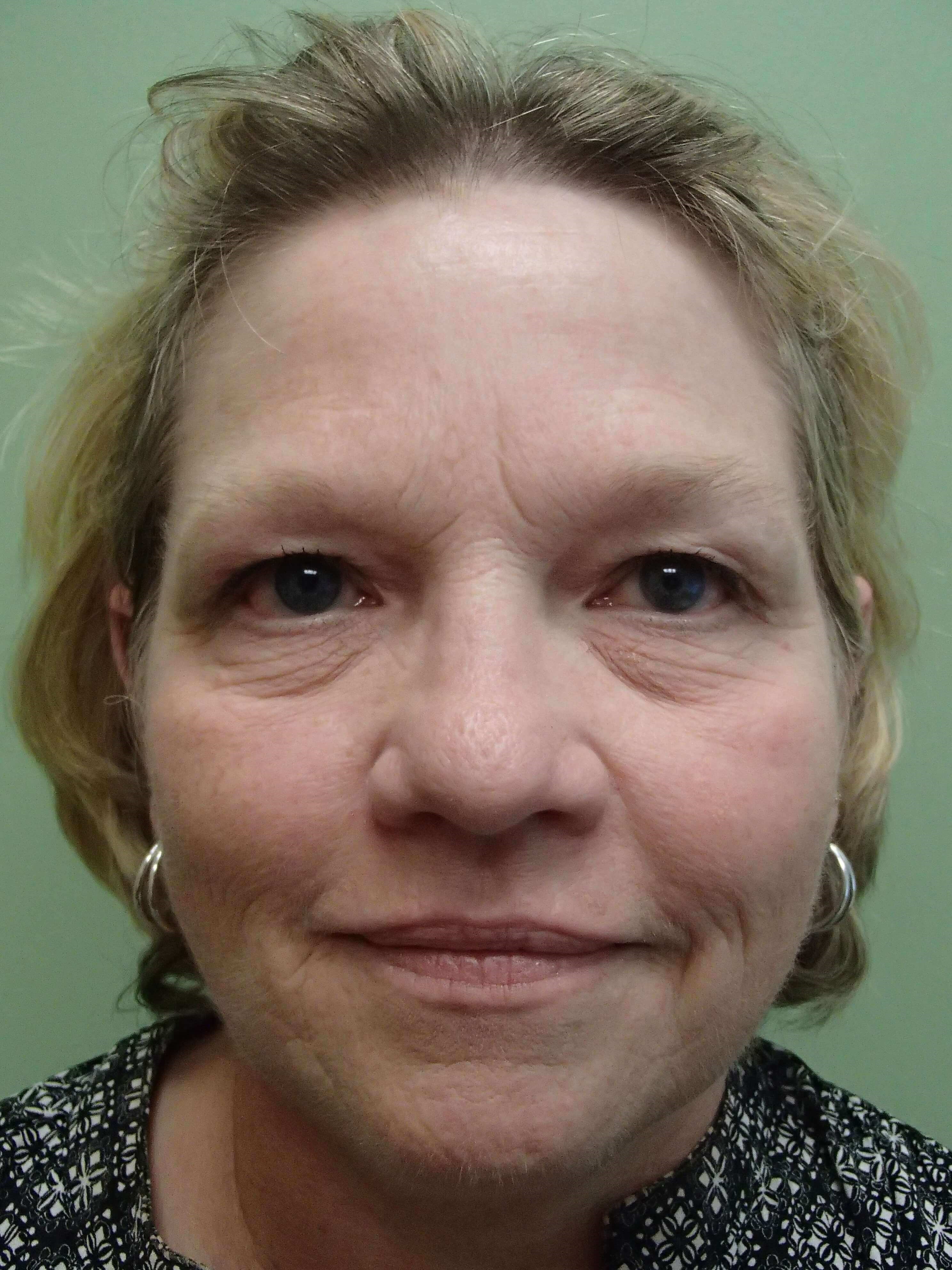 Blepharoplasty Before