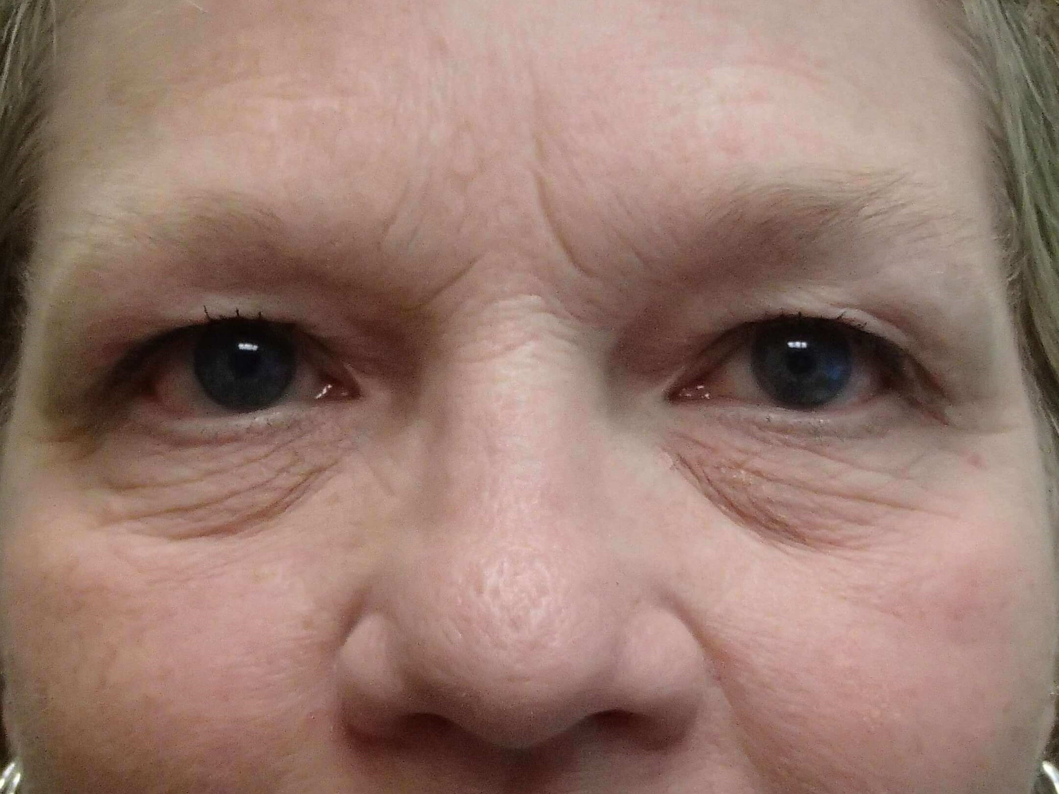 Blepharoplasty Before