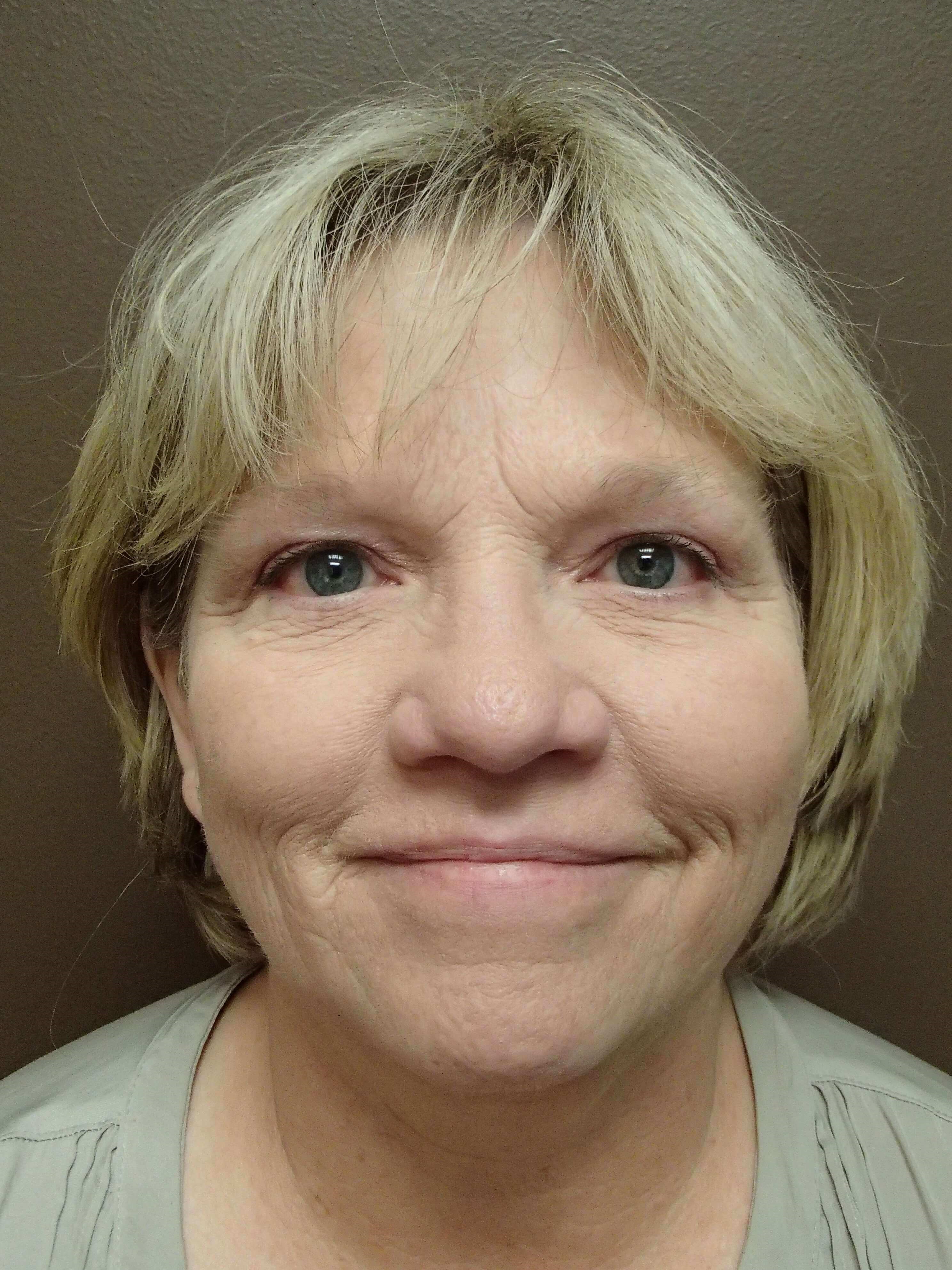 Blepharoplasty After