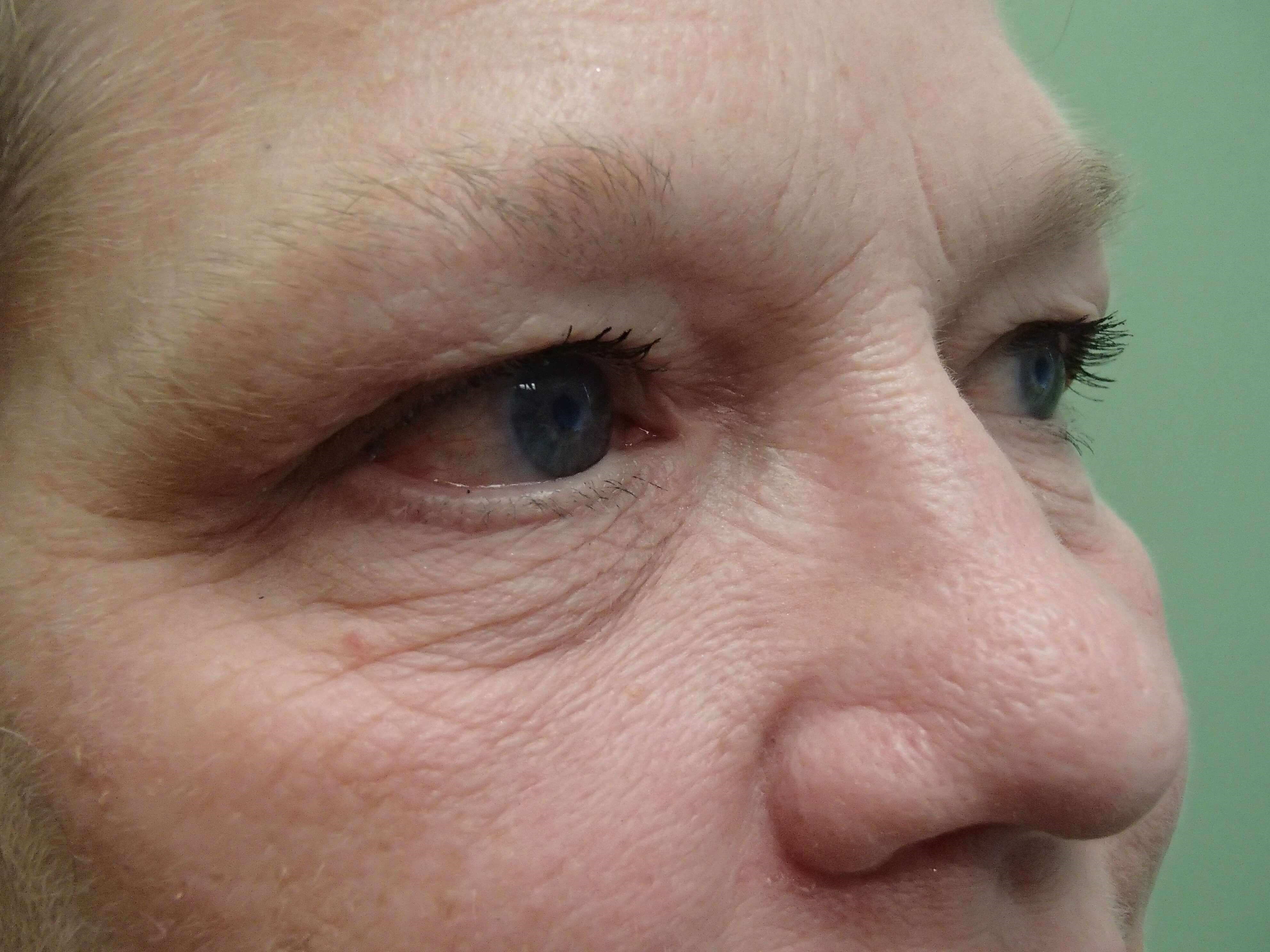 Blepharoplasty Before