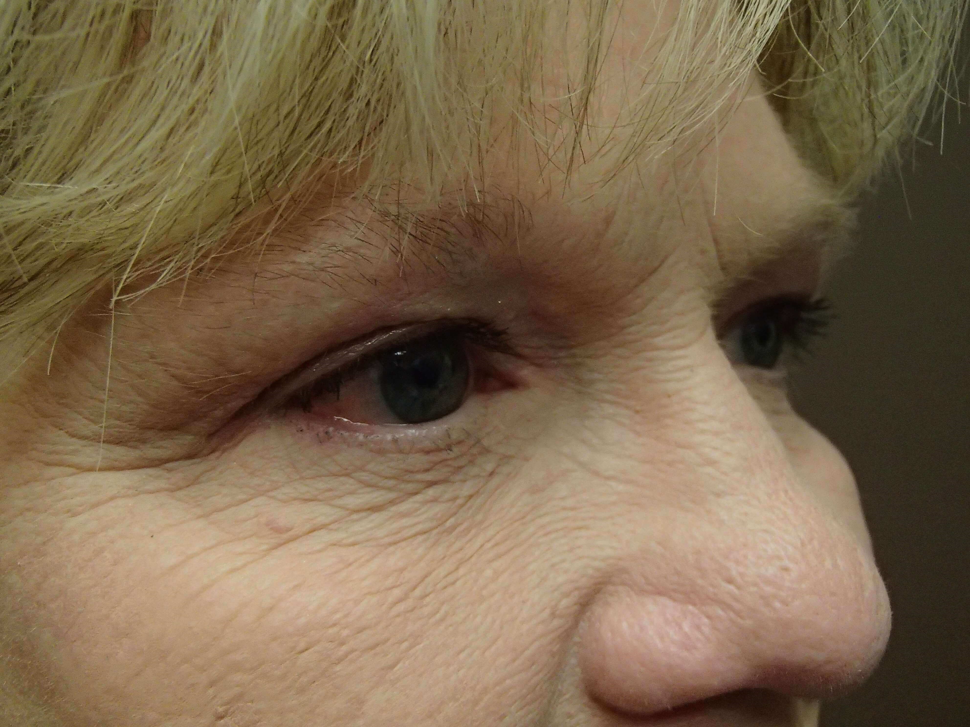 Blepharoplasty After