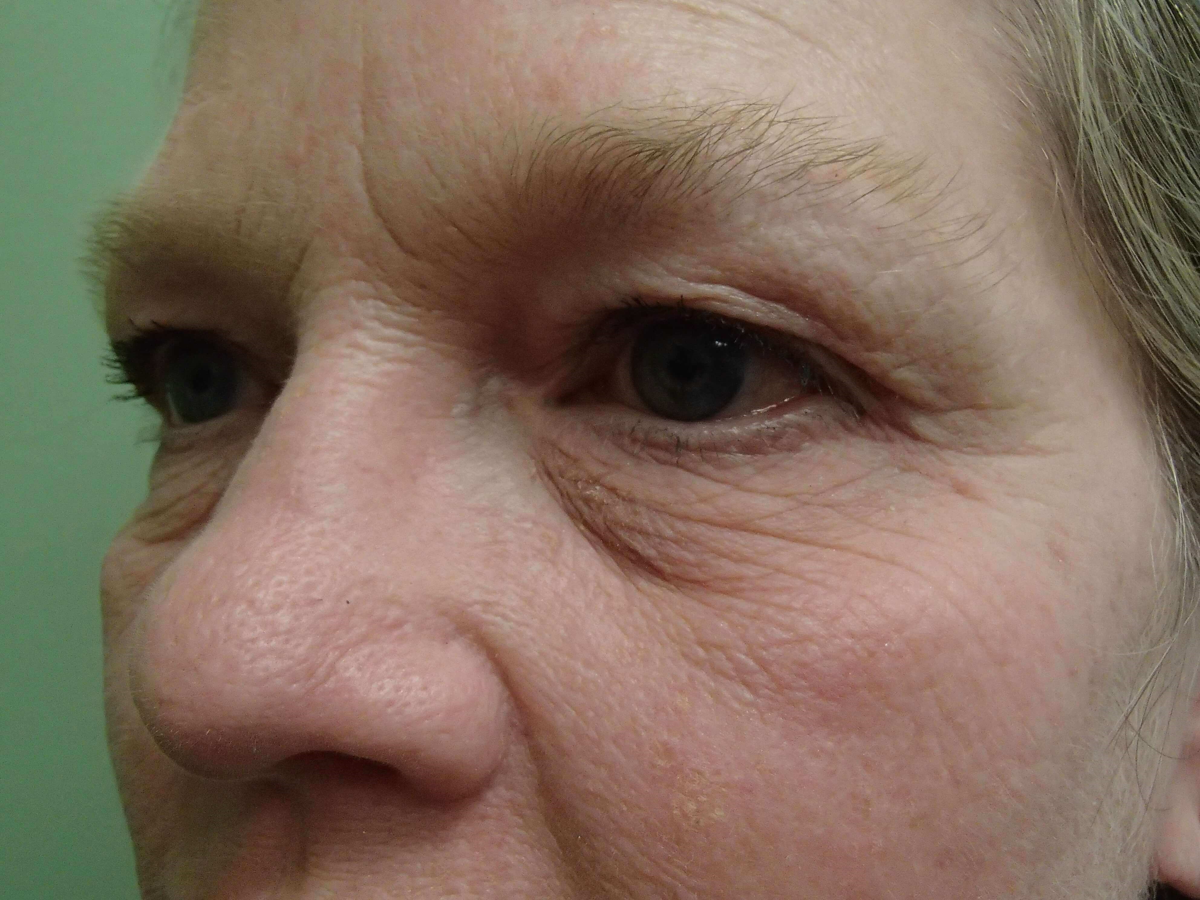 Blepharoplasty Before