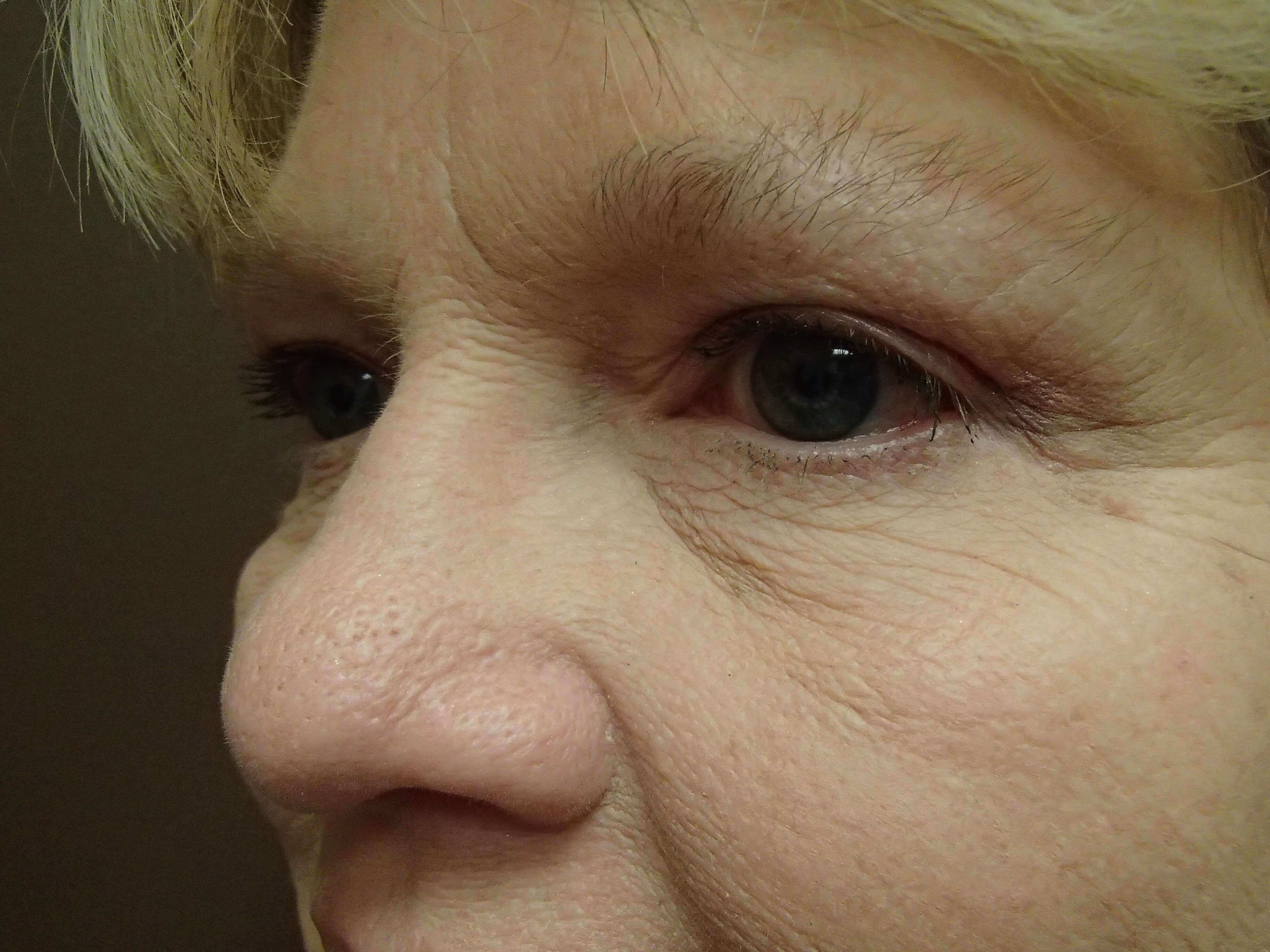 Blepharoplasty After