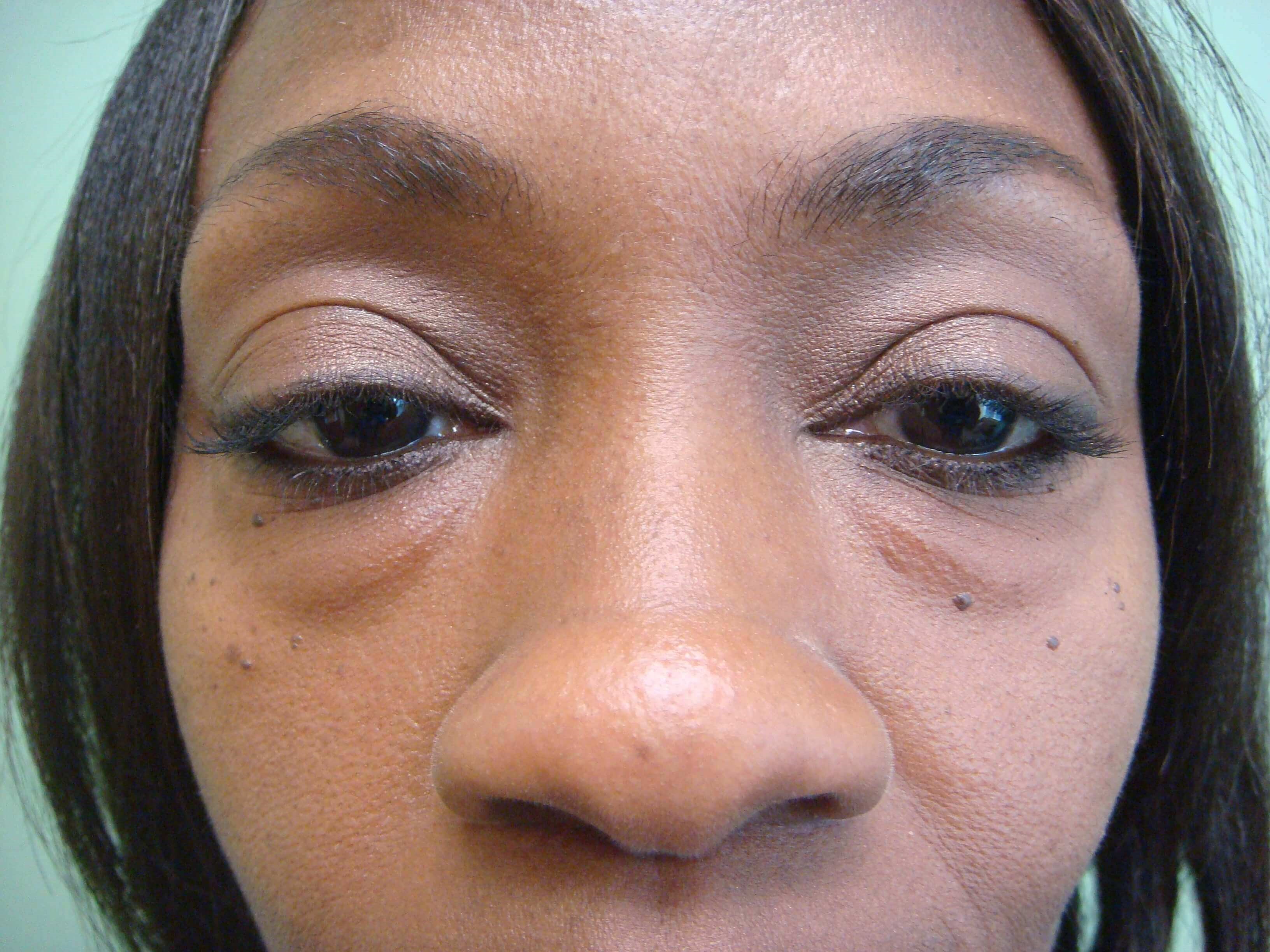 Blepharoplasty Before