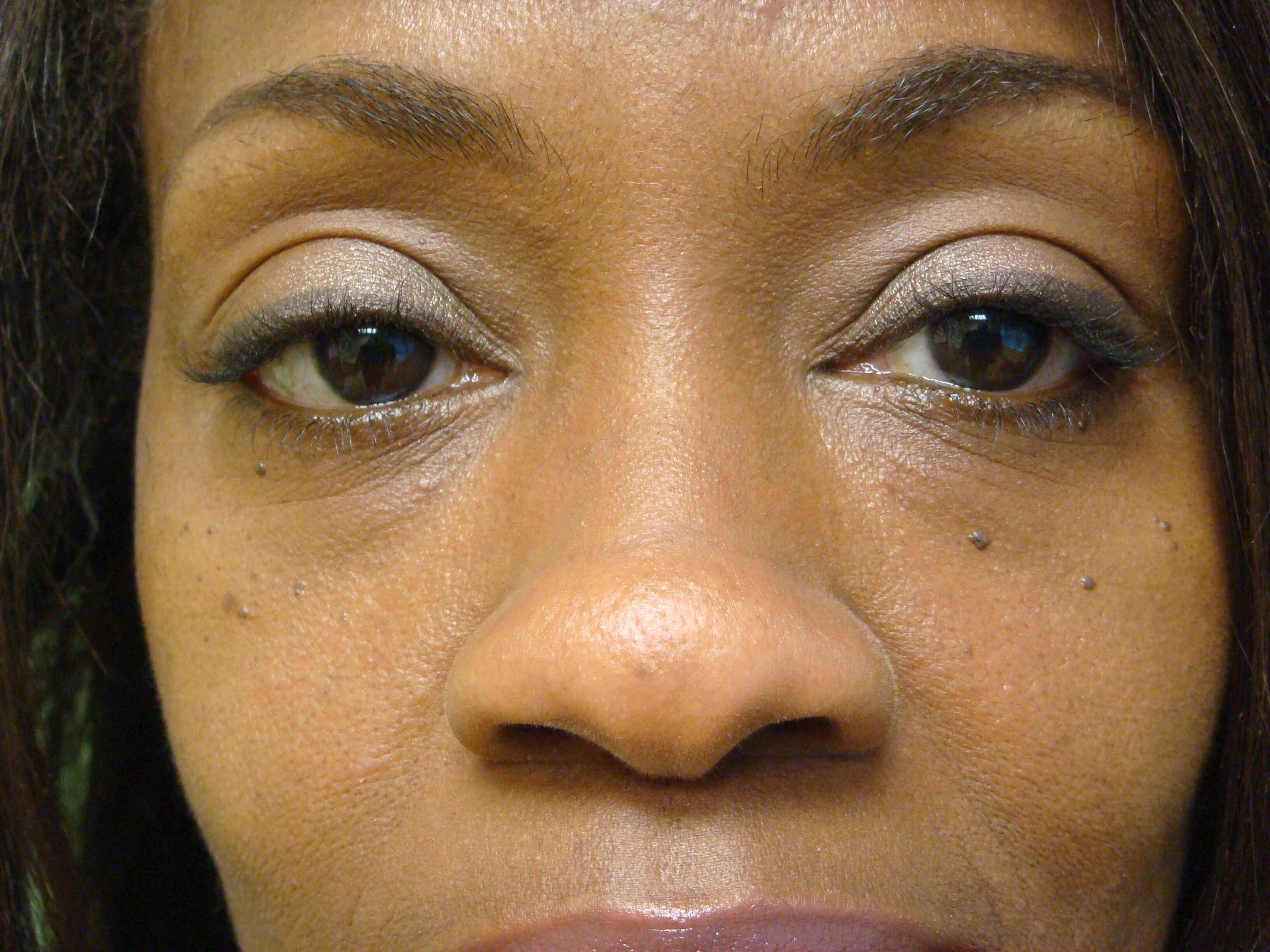 Blepharoplasty After