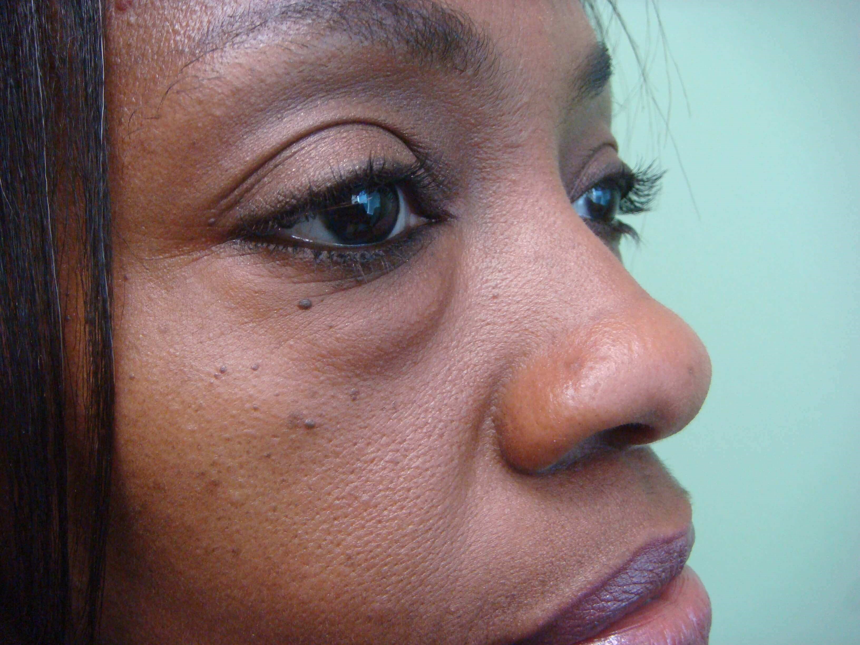 Blepharoplasty Before