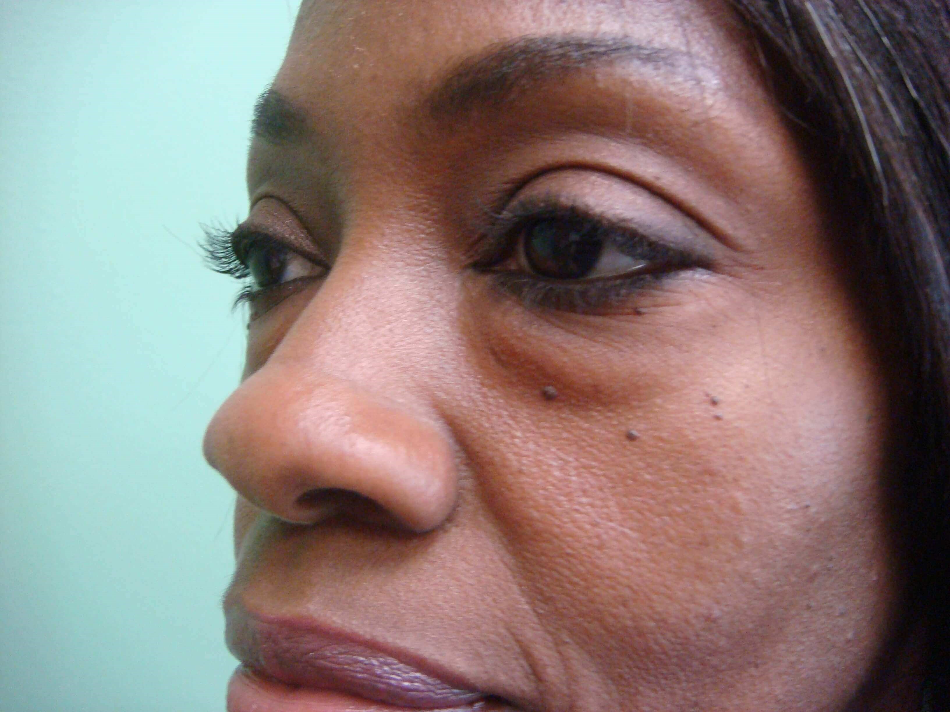 Blepharoplasty Before