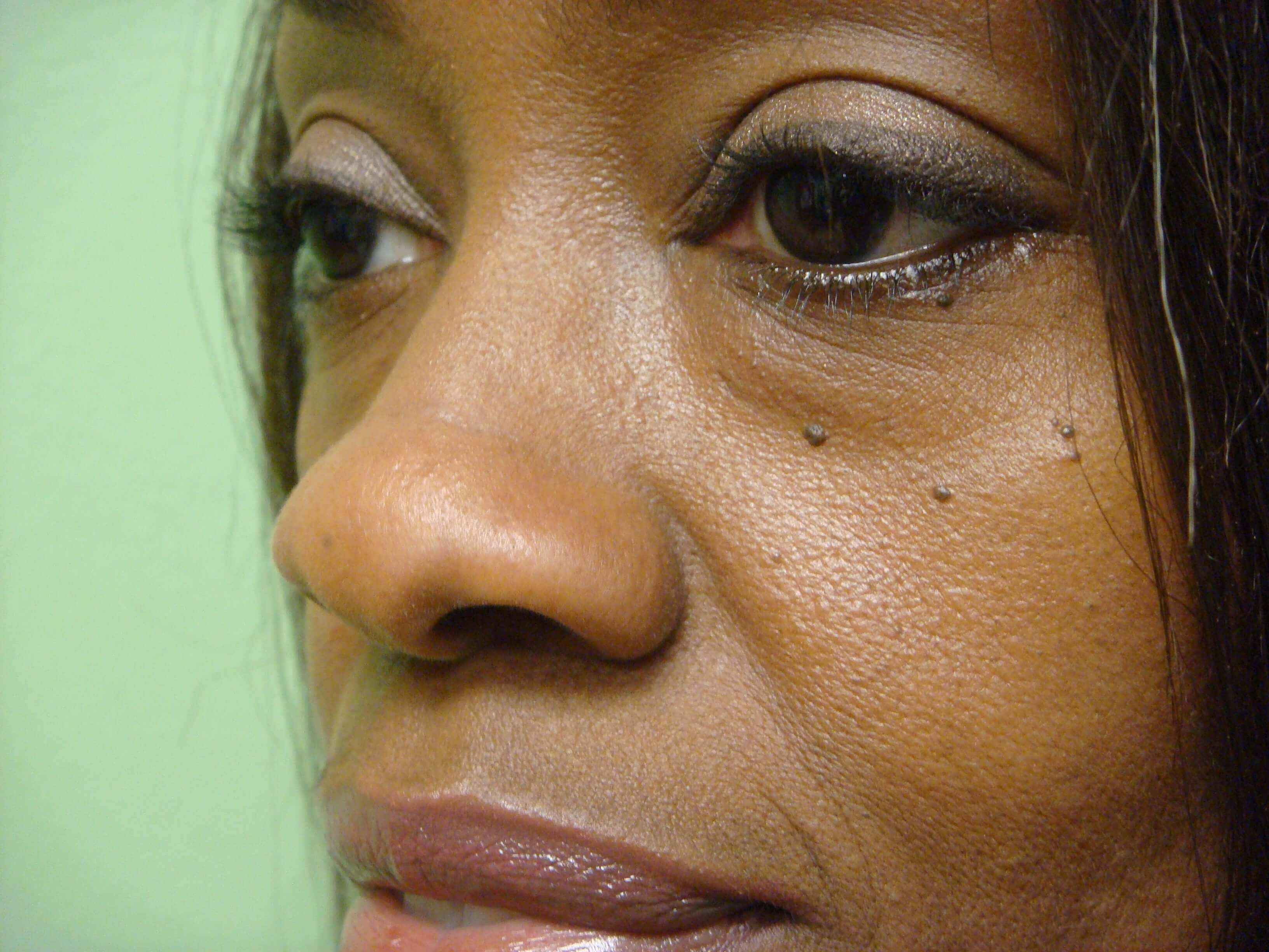 Blepharoplasty After
