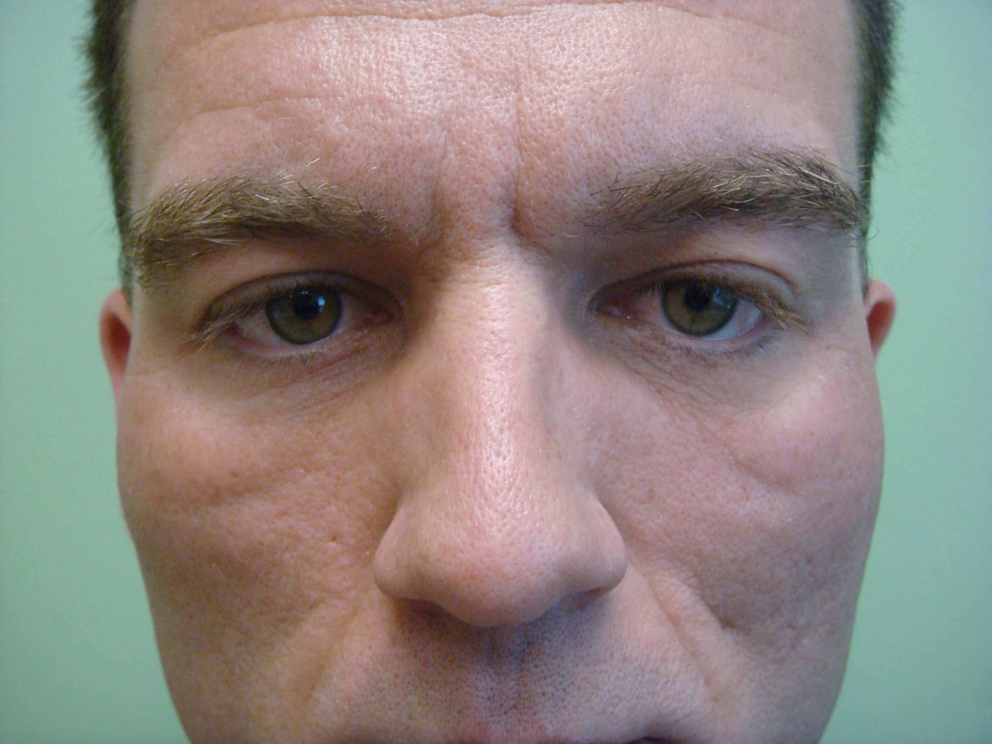 Blepharoplasty Before