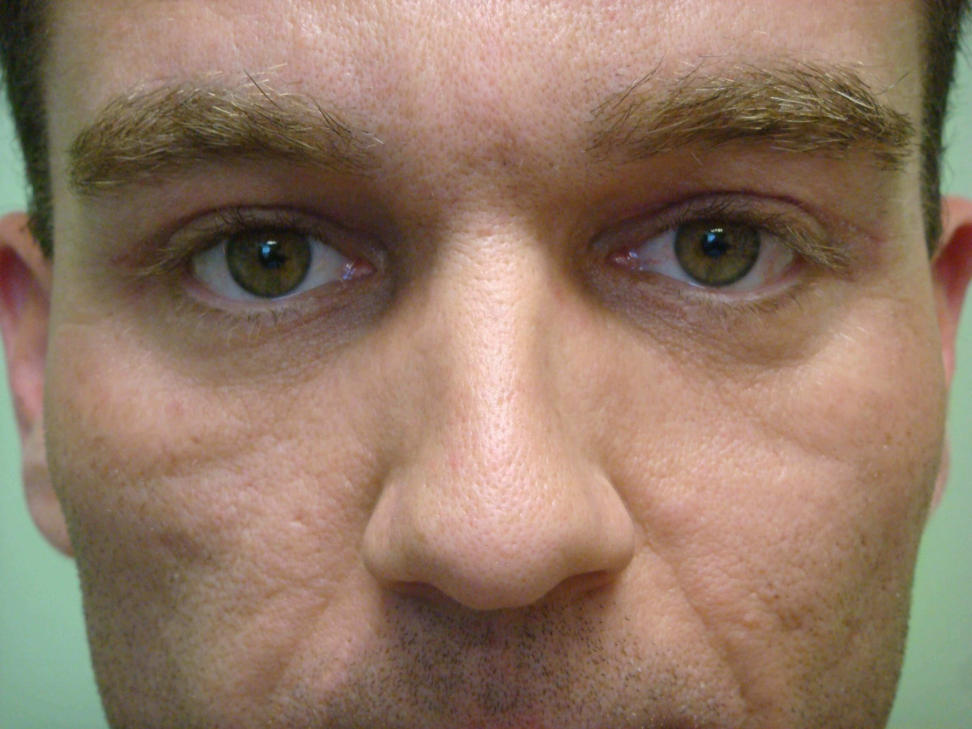 Blepharoplasty After