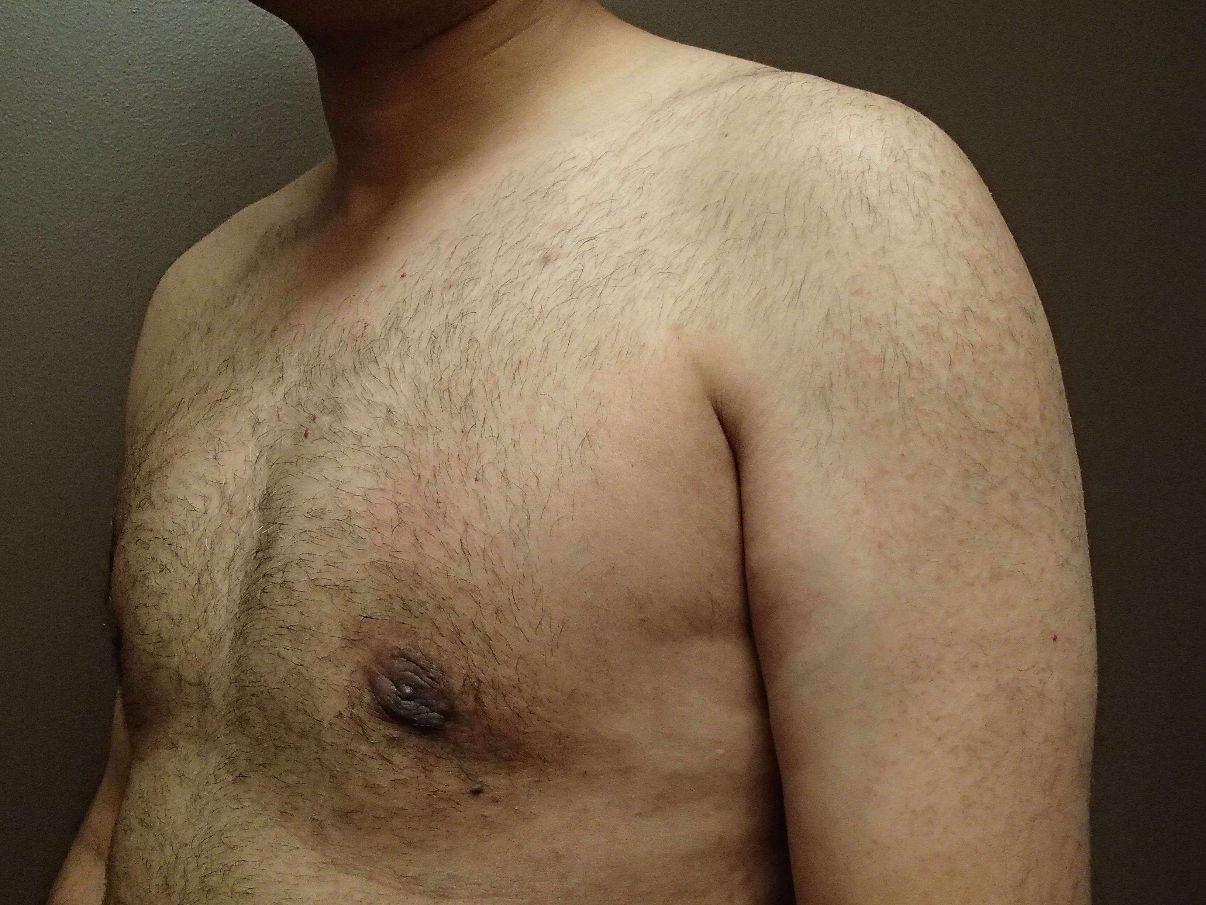 Gynecomastia (male breast redu After