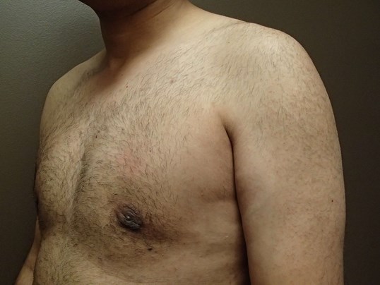Gynecomastia (male breast redu After