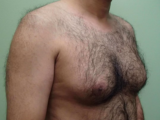 Gynecomastia (male breast redu Before