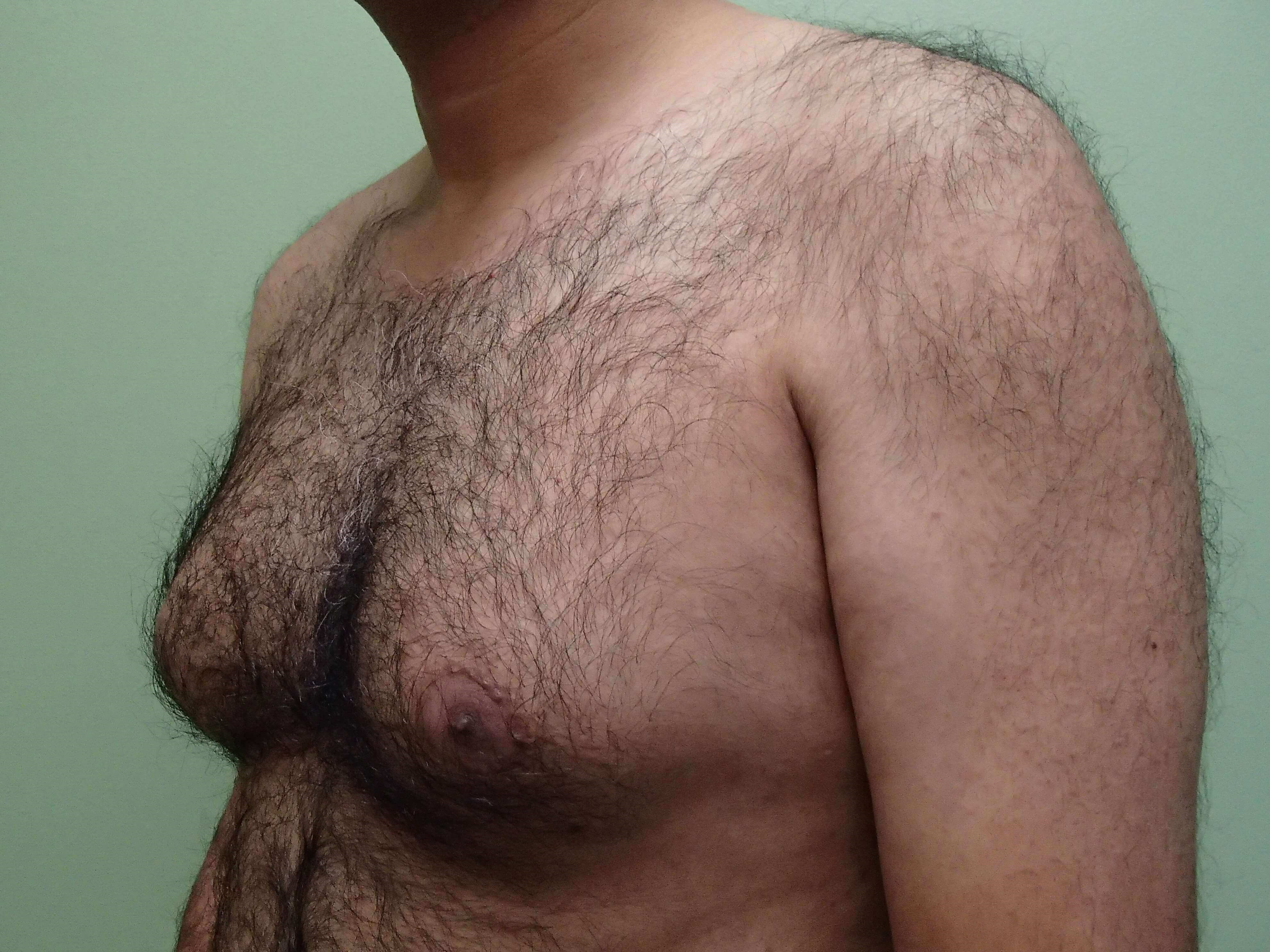 Gynecomastia (male breast redu Before