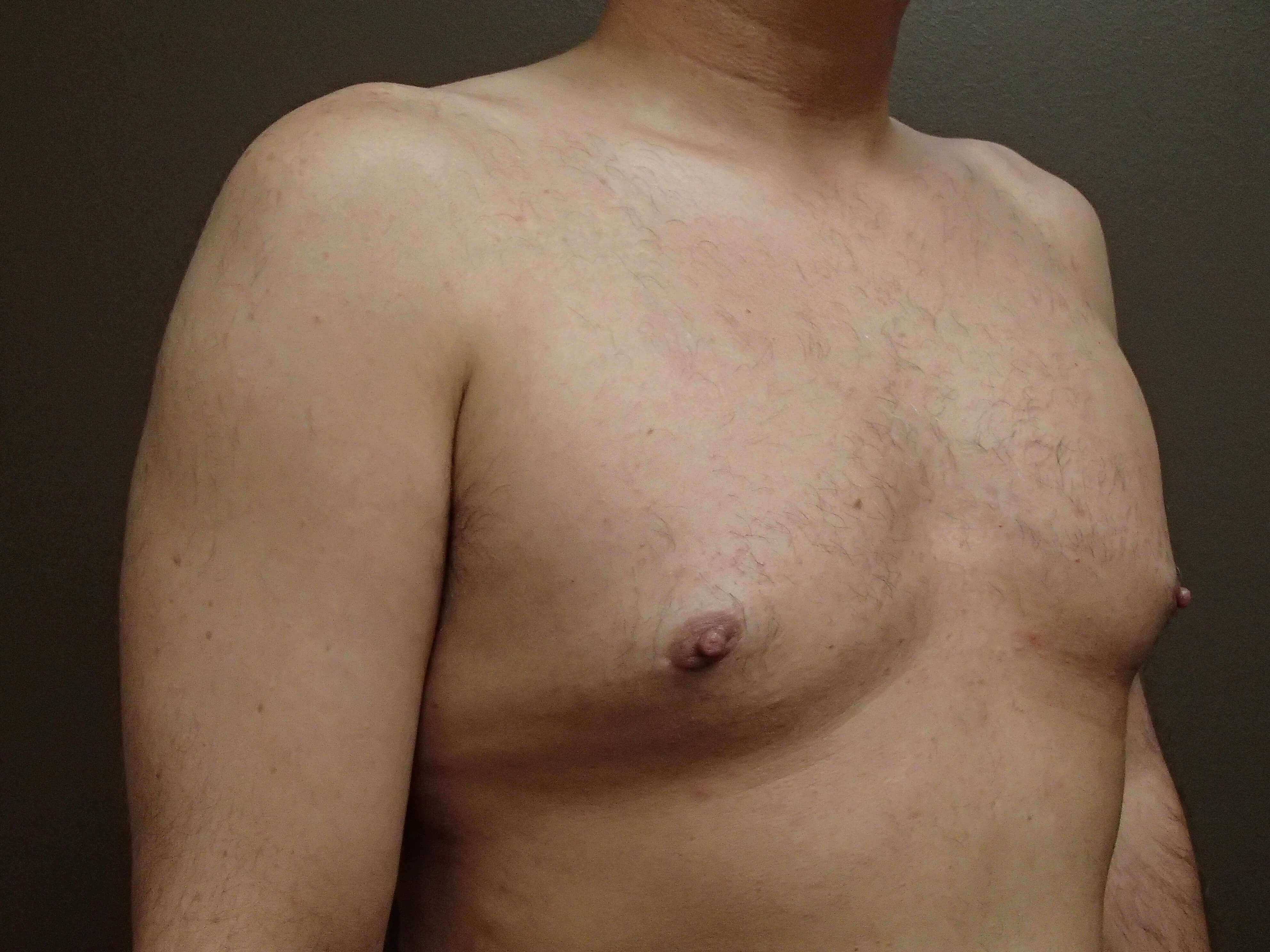 Gynecomastia (male breast redu After
