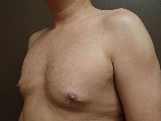 Gynecomastia (male breast redu After