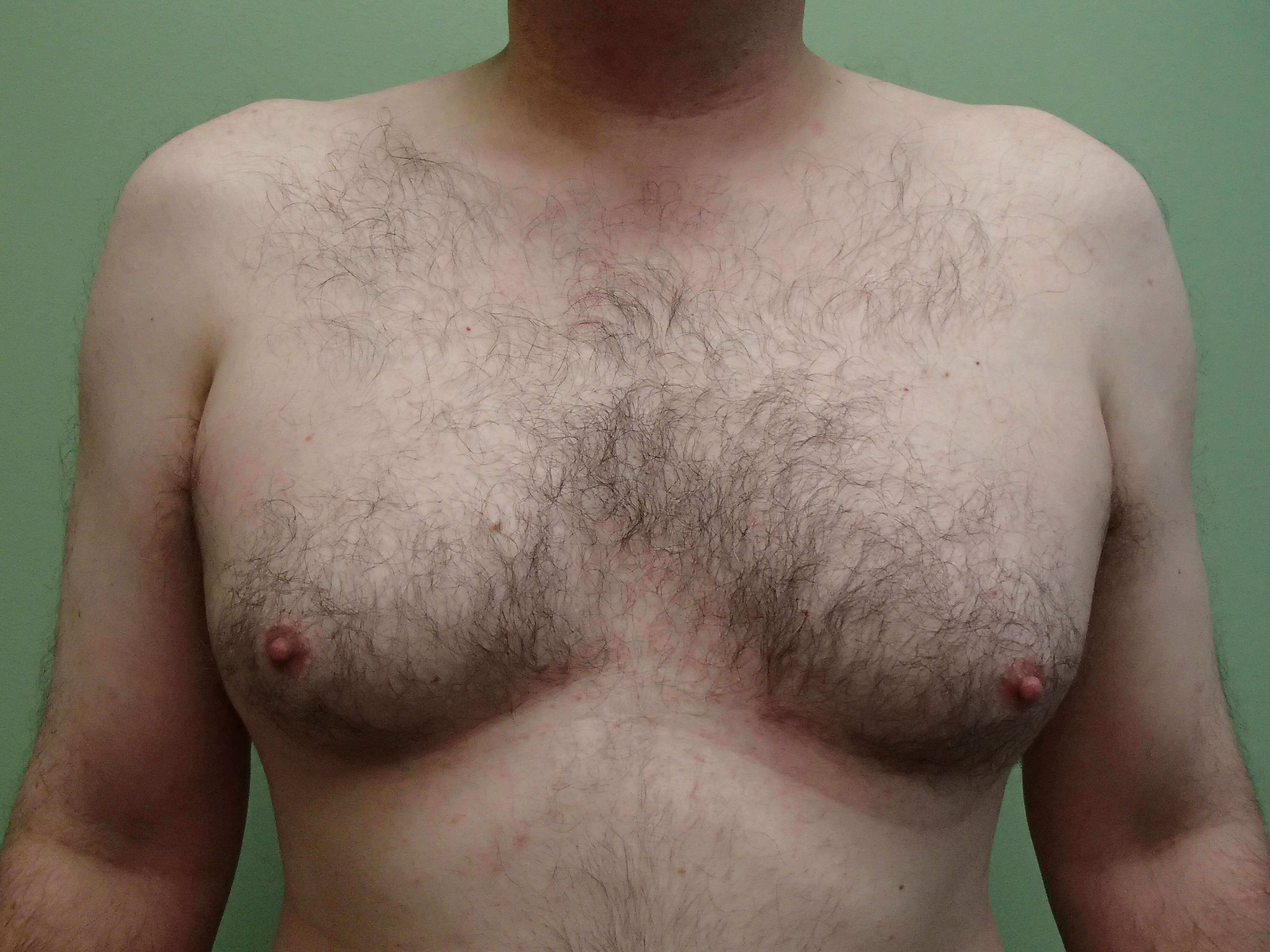 Gynecomastia (male breast redu Before