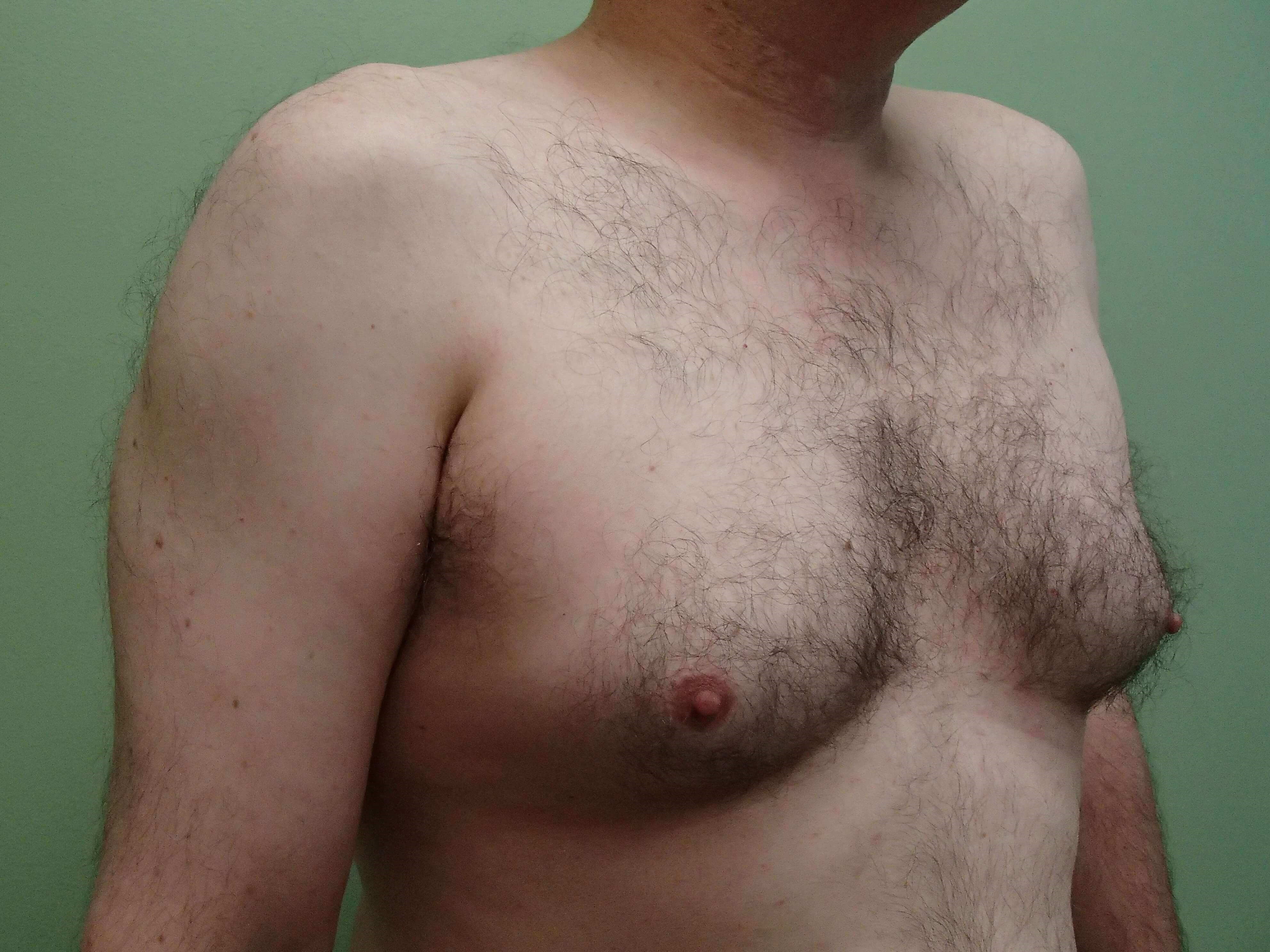 Gynecomastia (male breast redu Before