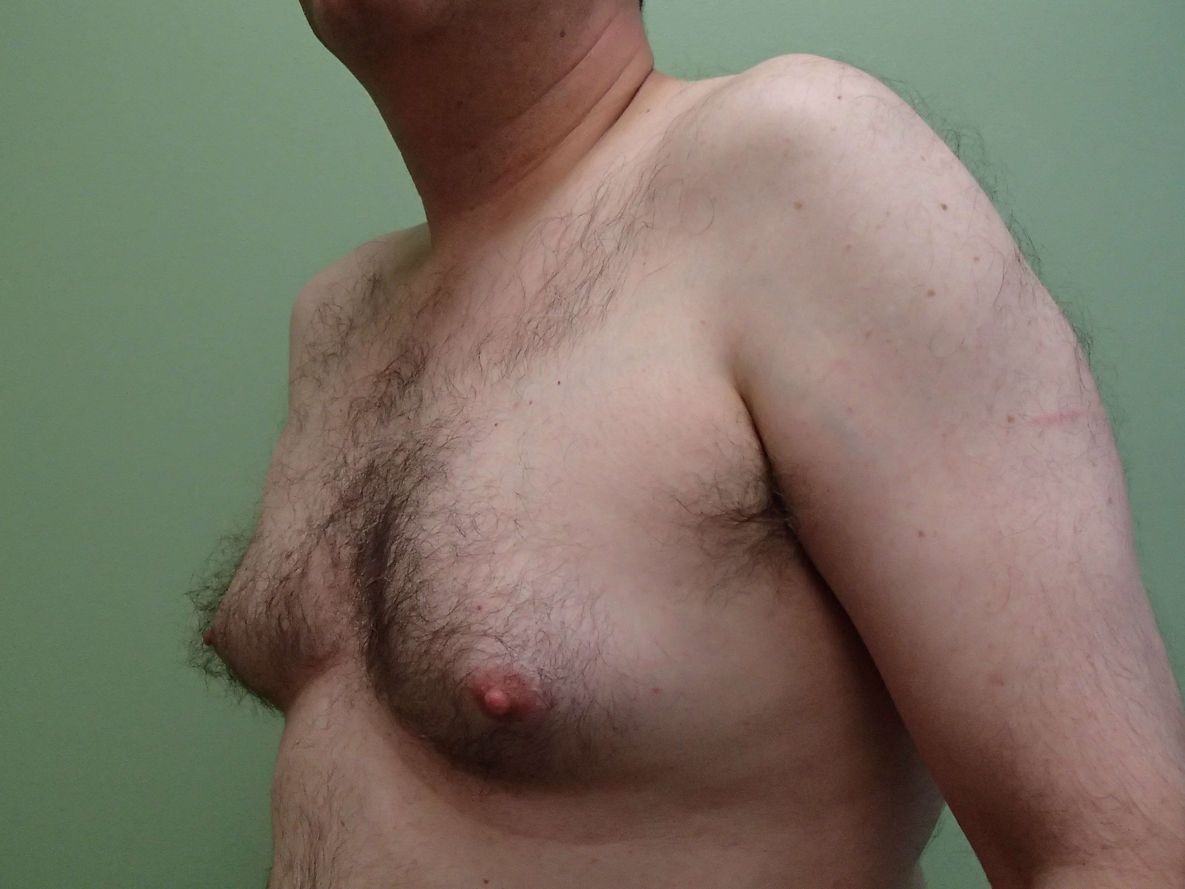 Gynecomastia (male breast redu Before