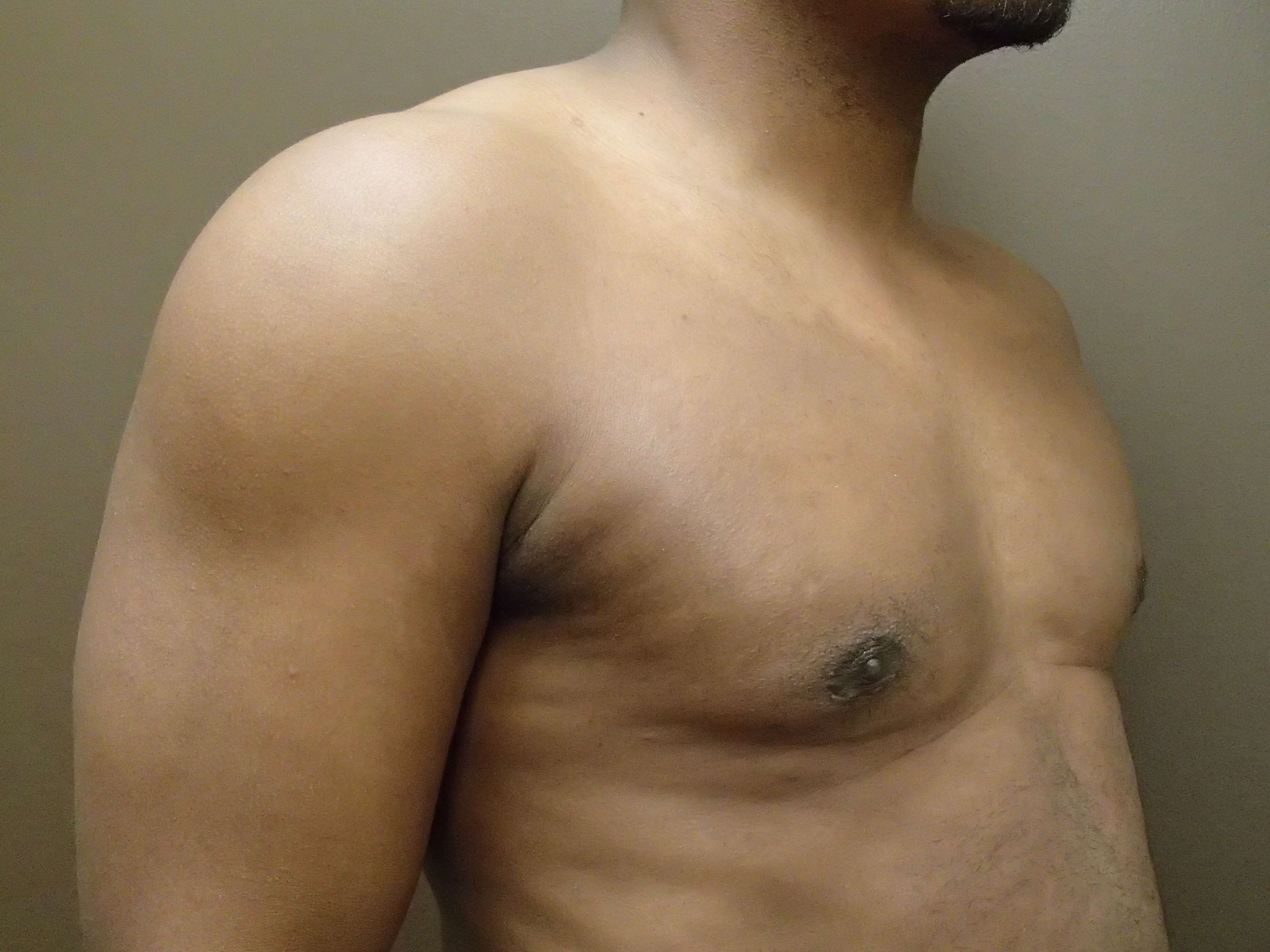 Gynecomastia (male breast redu After