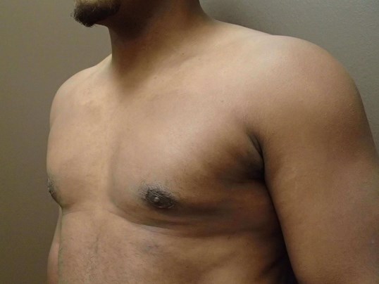Gynecomastia (male breast redu After