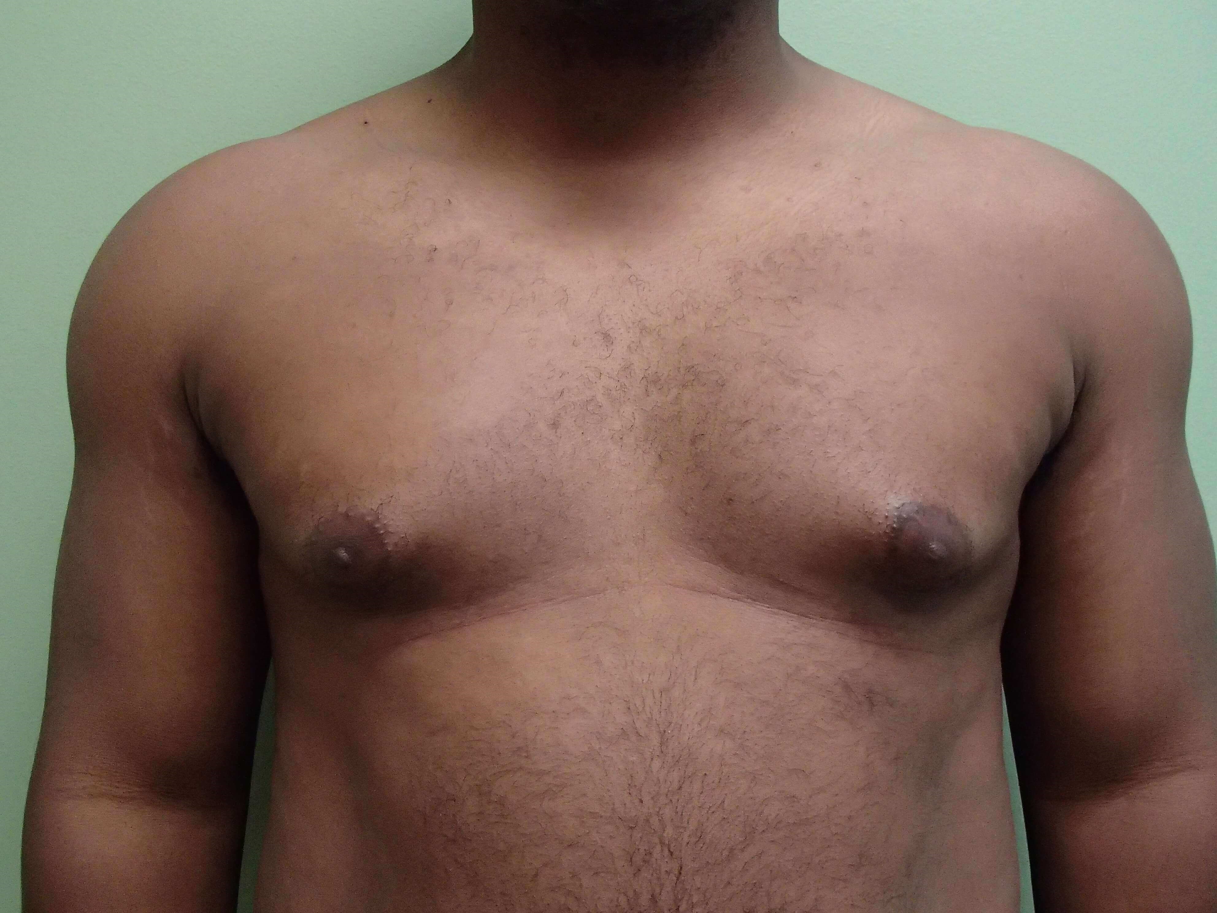 Gynecomastia (male breast redu Before