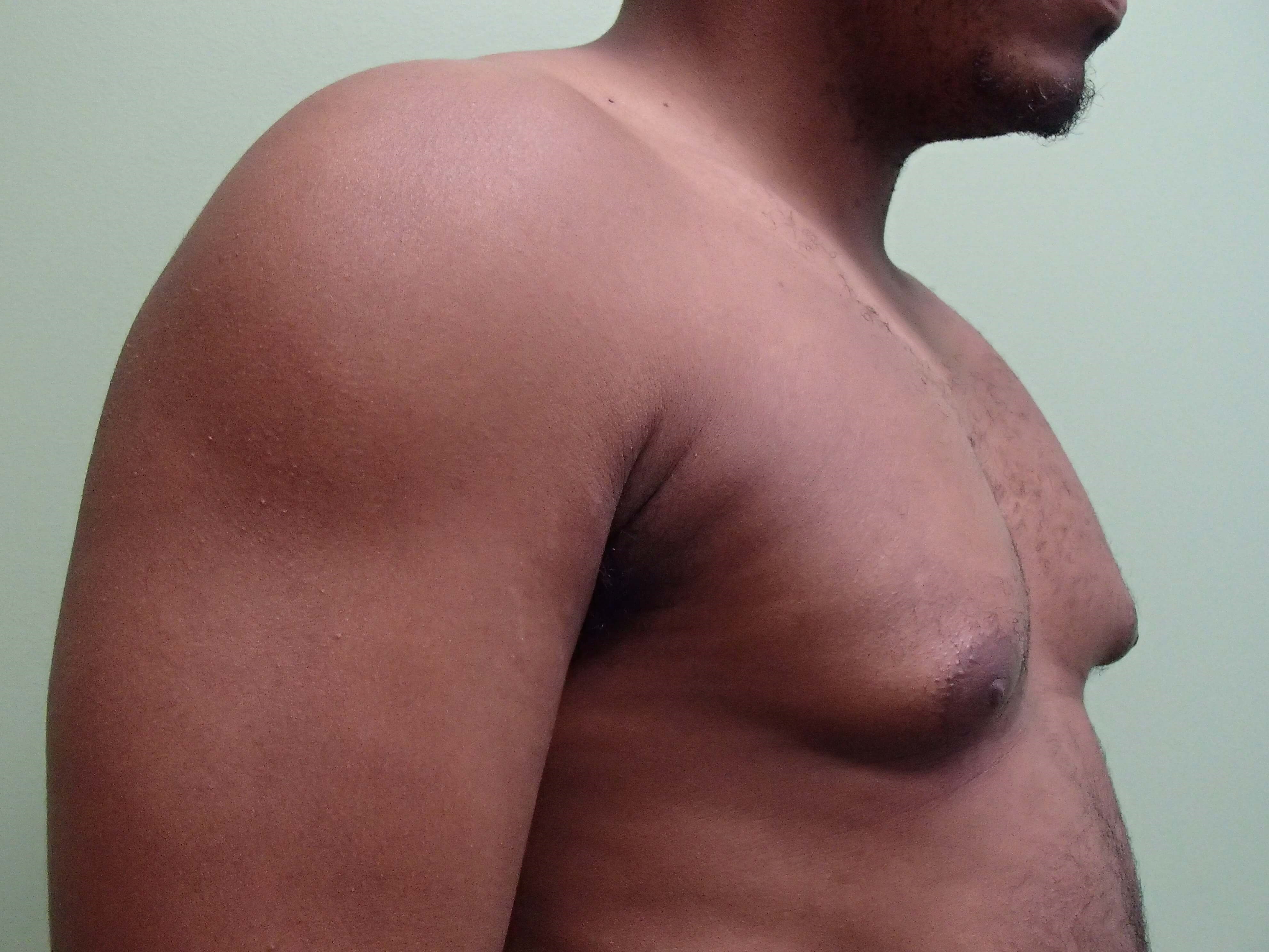 Gynecomastia (male breast redu Before