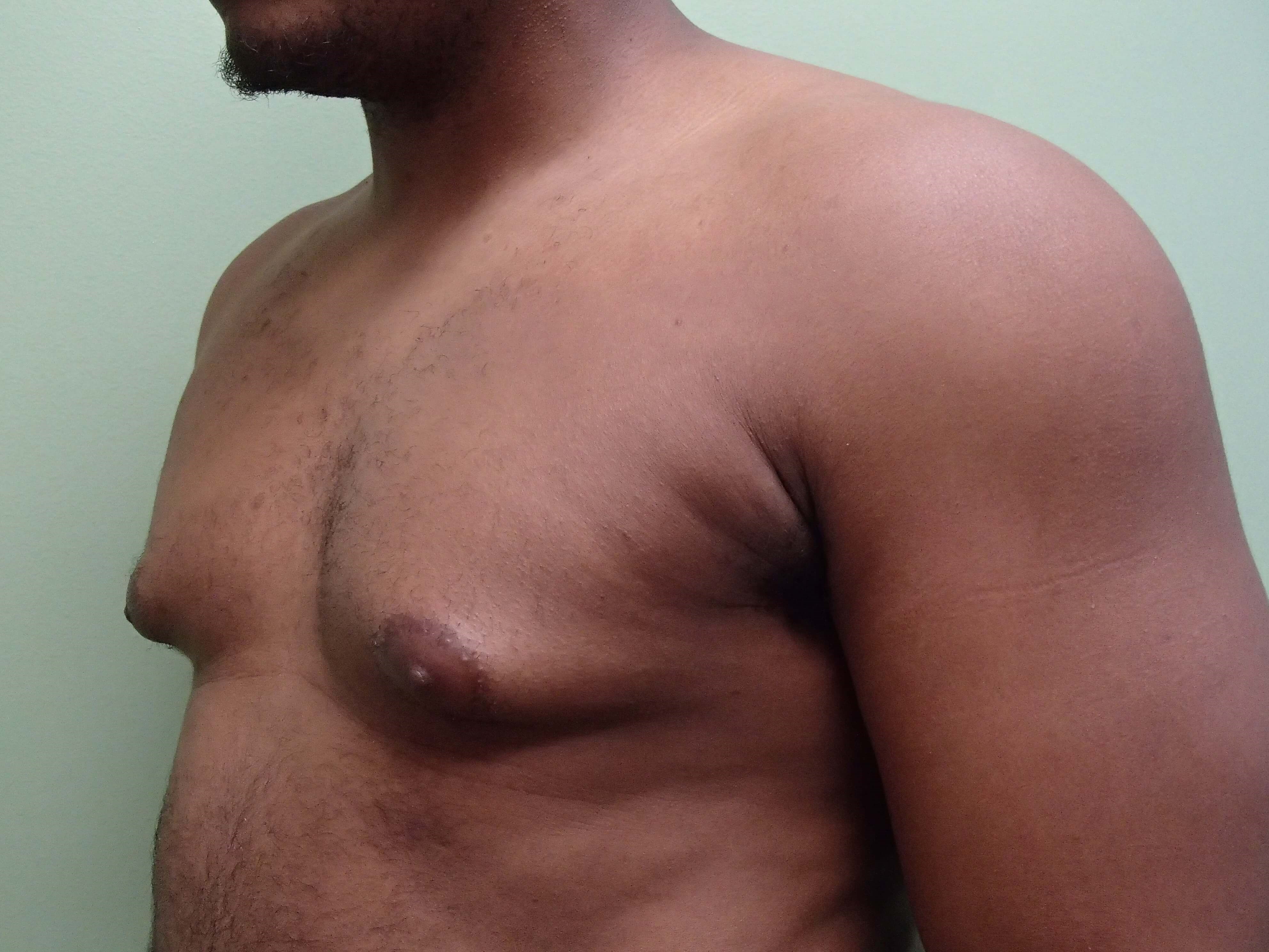 Gynecomastia (male breast redu Before