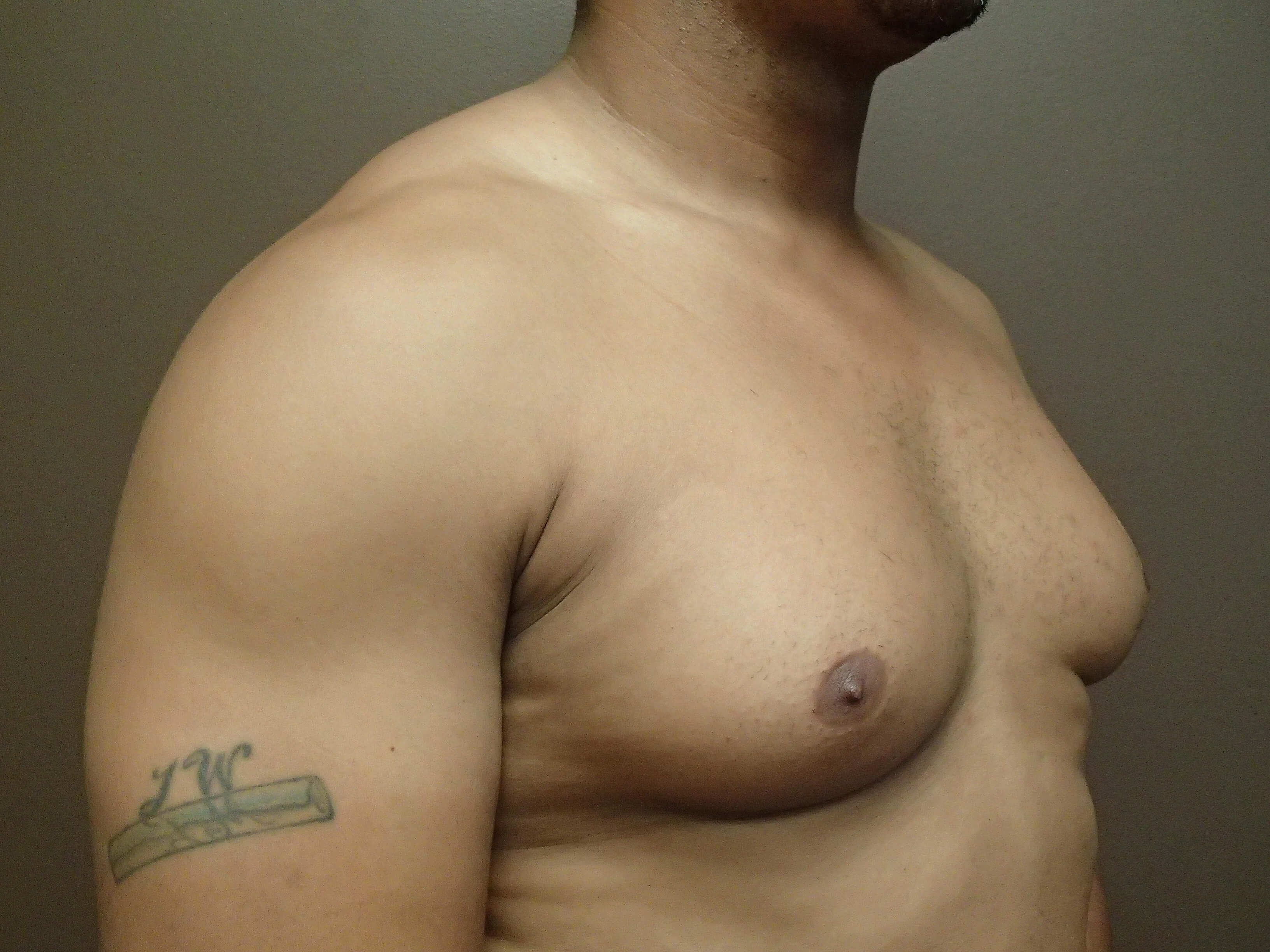 Gynecomastia (male breast redu Before