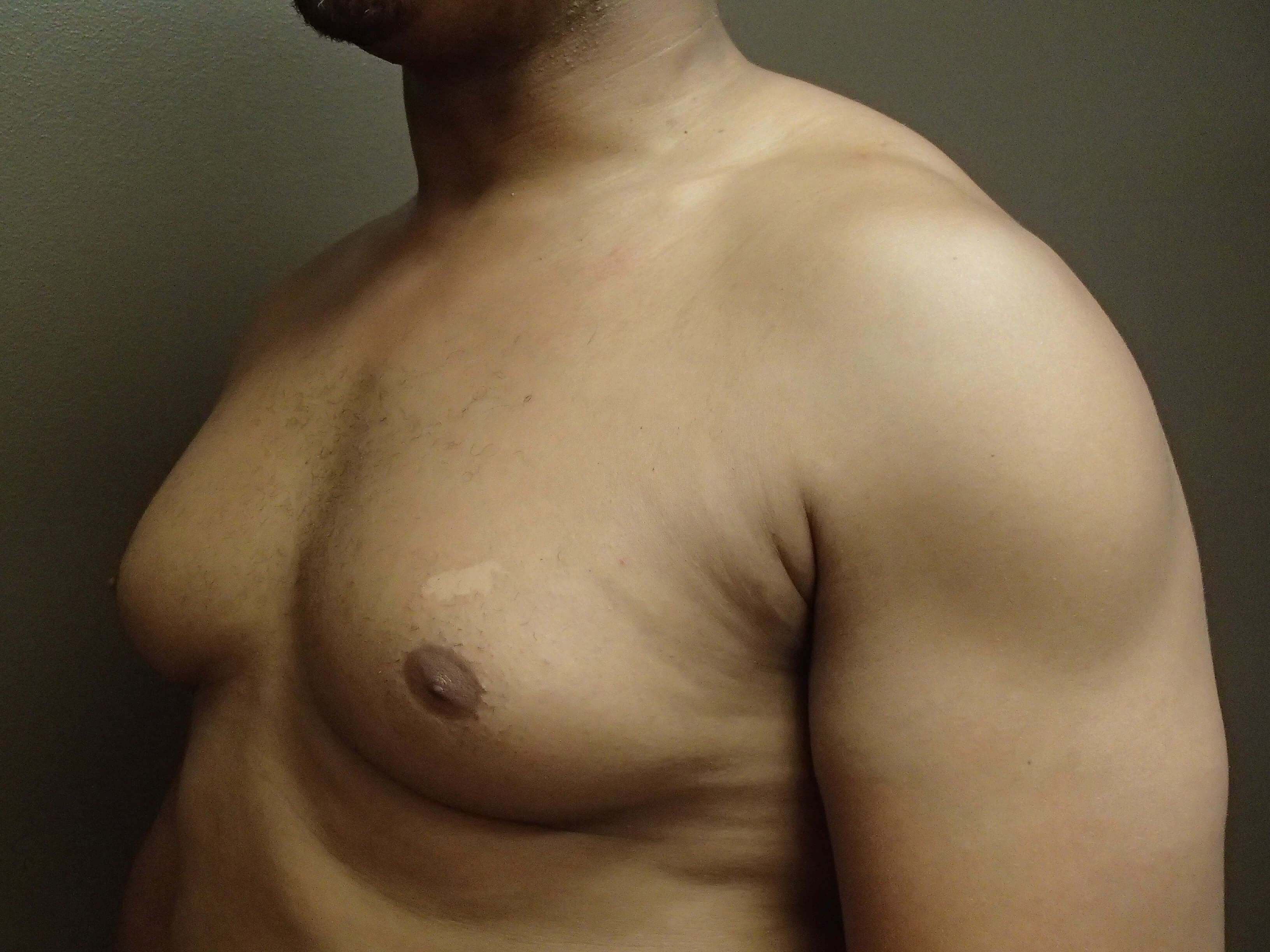 Gynecomastia (male breast redu Before