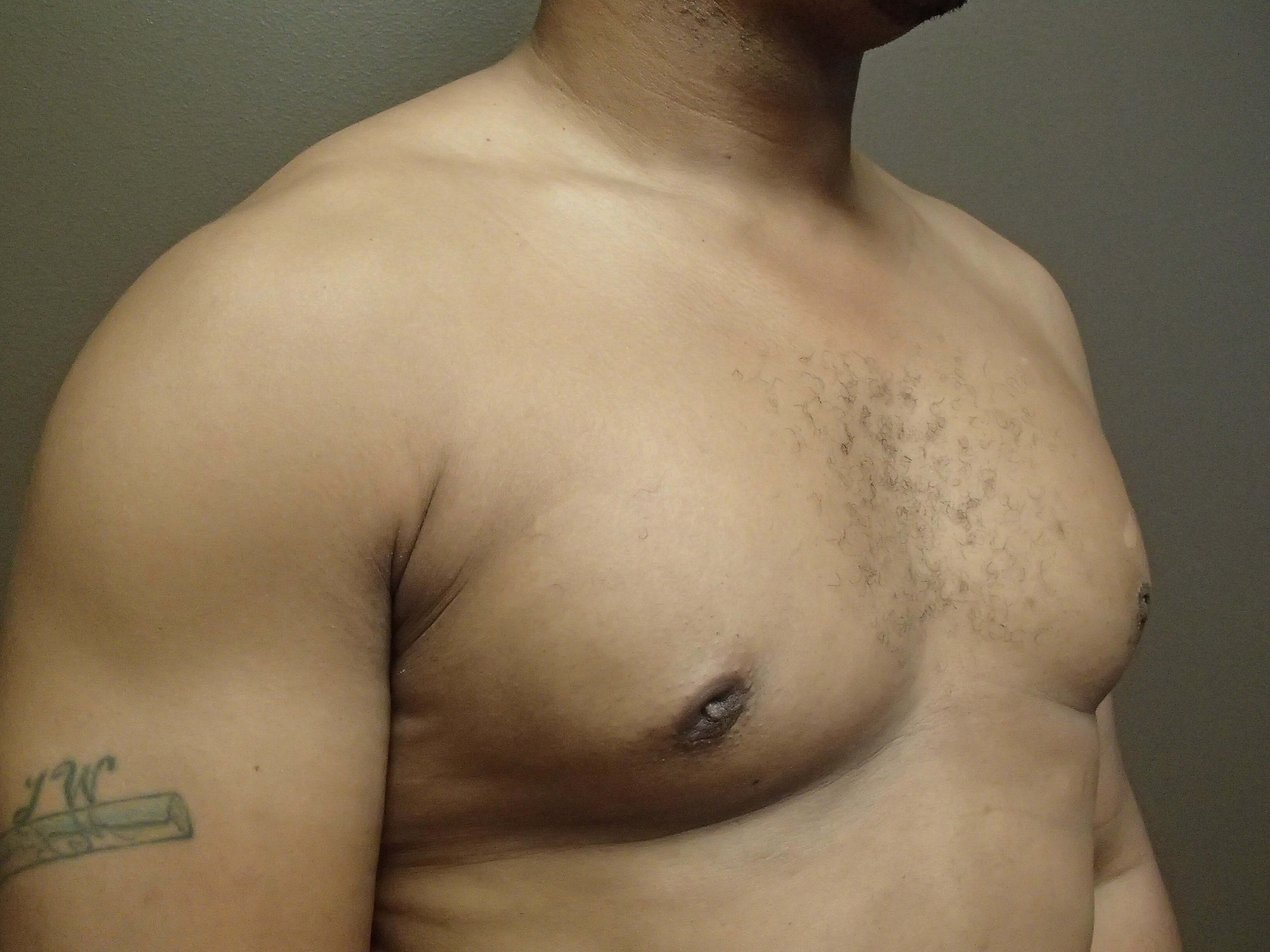 Gynecomastia (male breast redu After