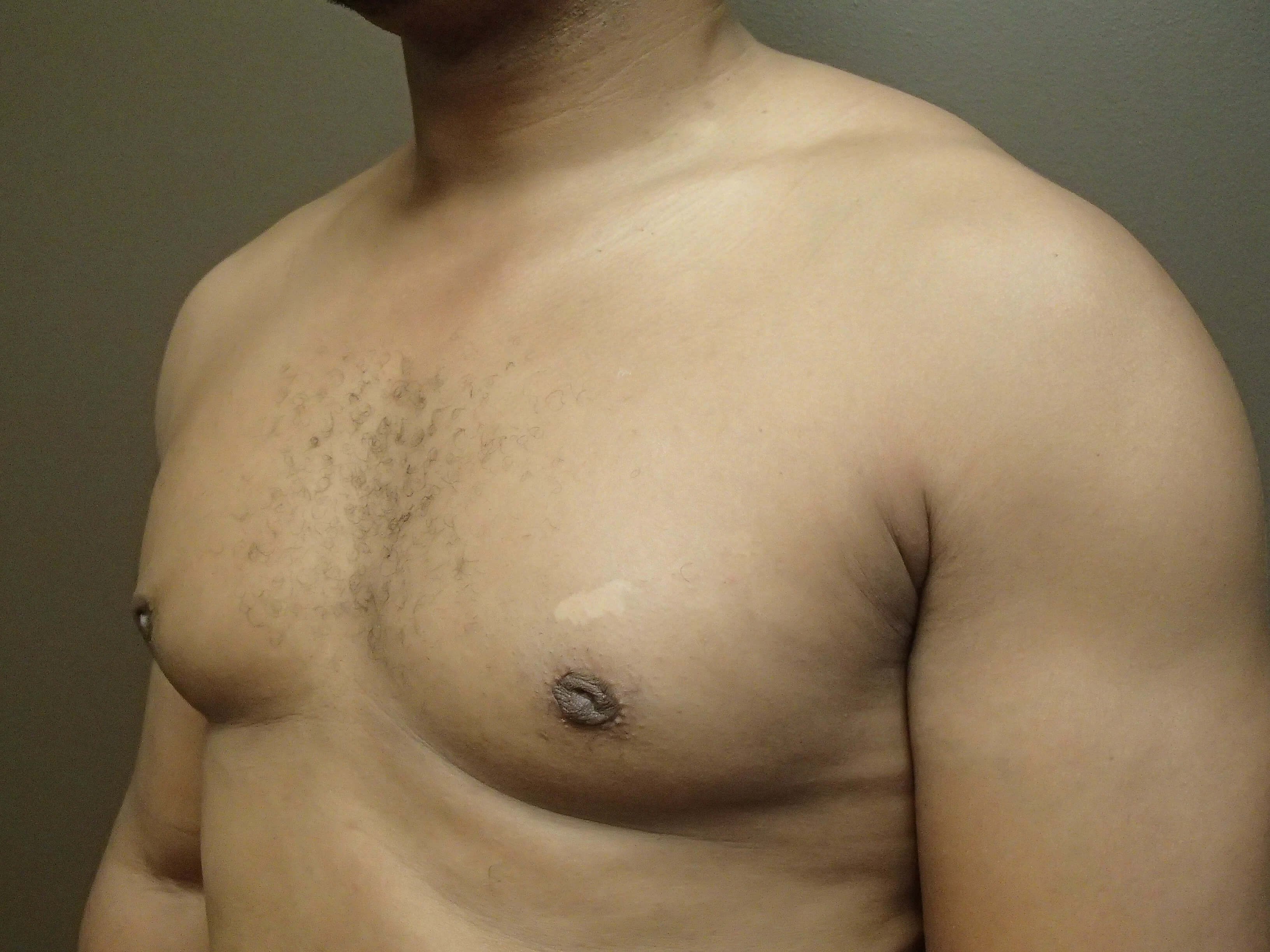 Gynecomastia (male breast redu After