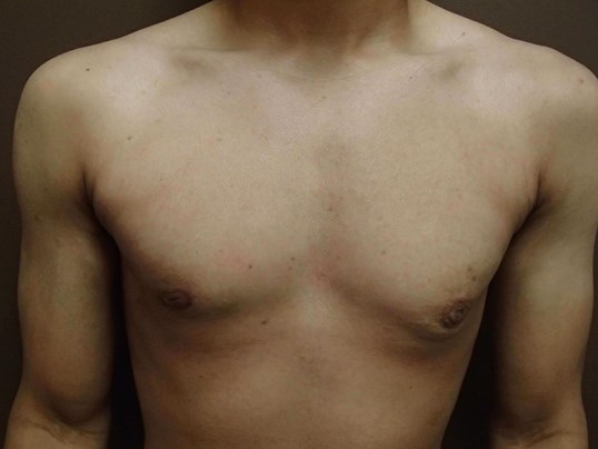 Gynecomastia (male breast redu After