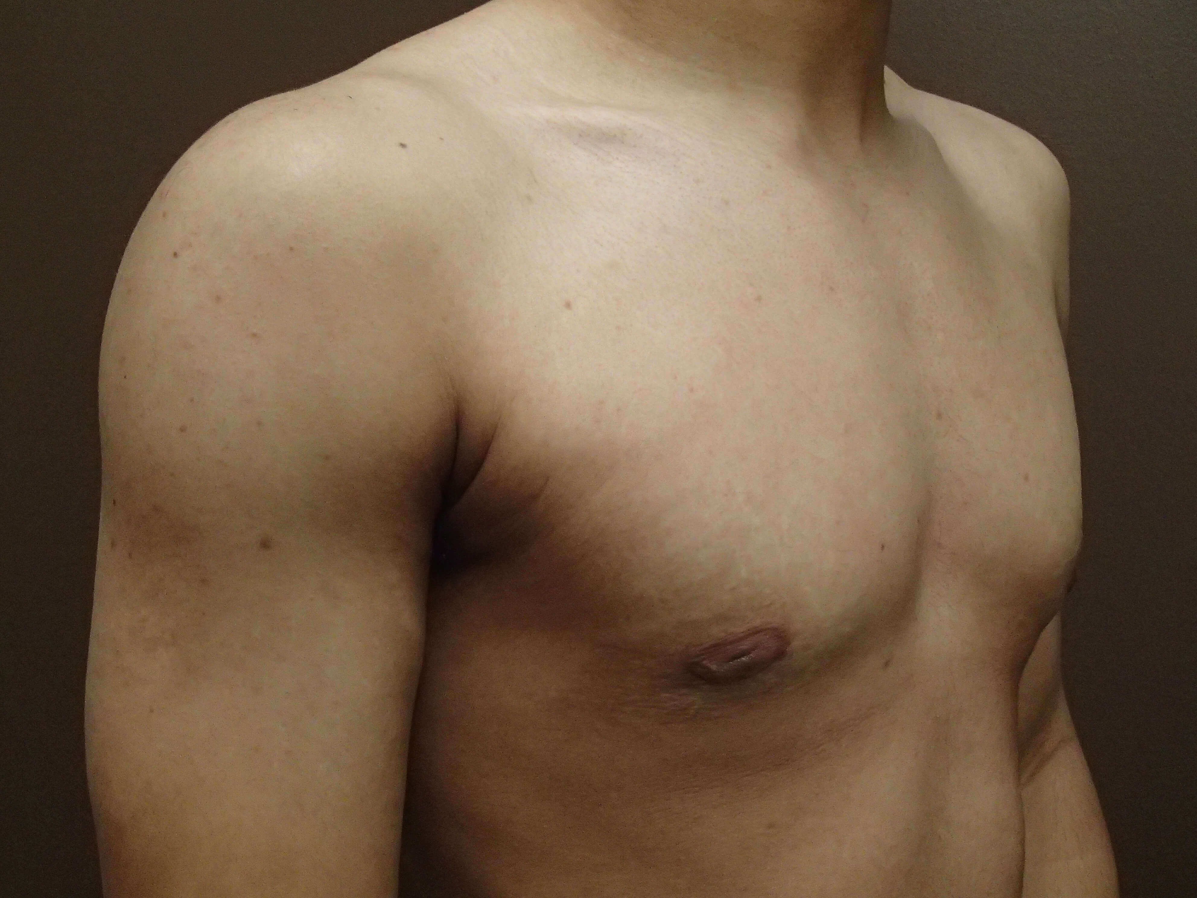 Gynecomastia (male breast redu After