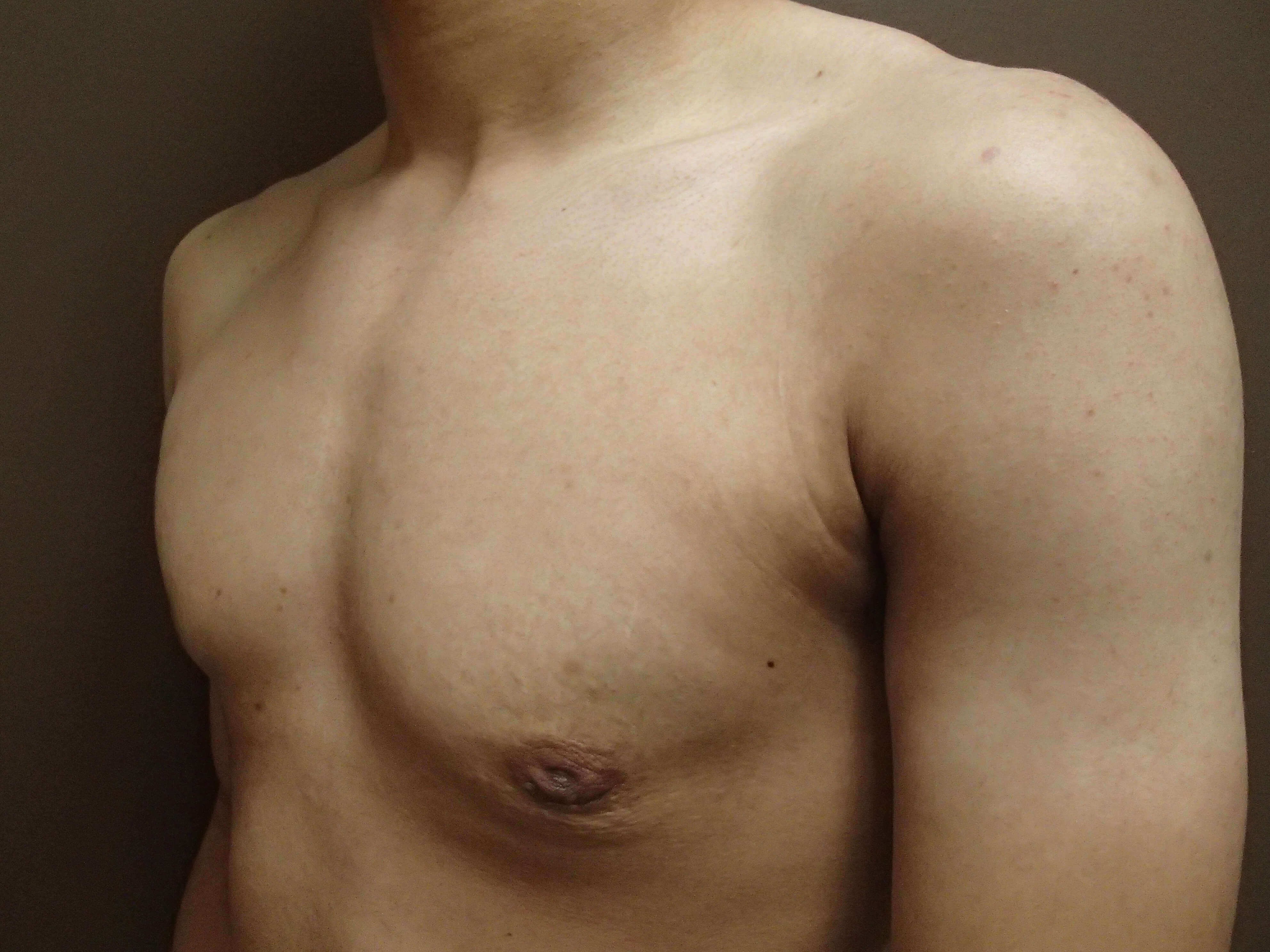 Gynecomastia (male breast redu After