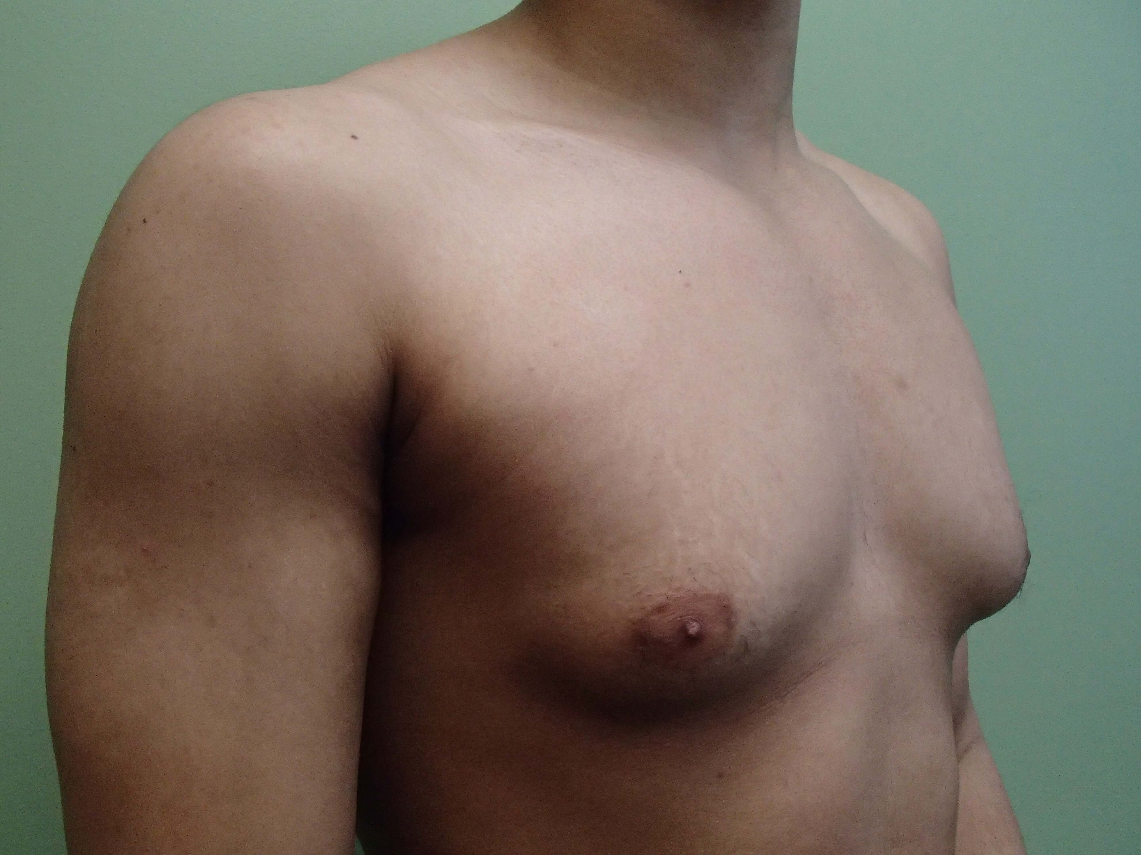 Gynecomastia (male breast redu Before