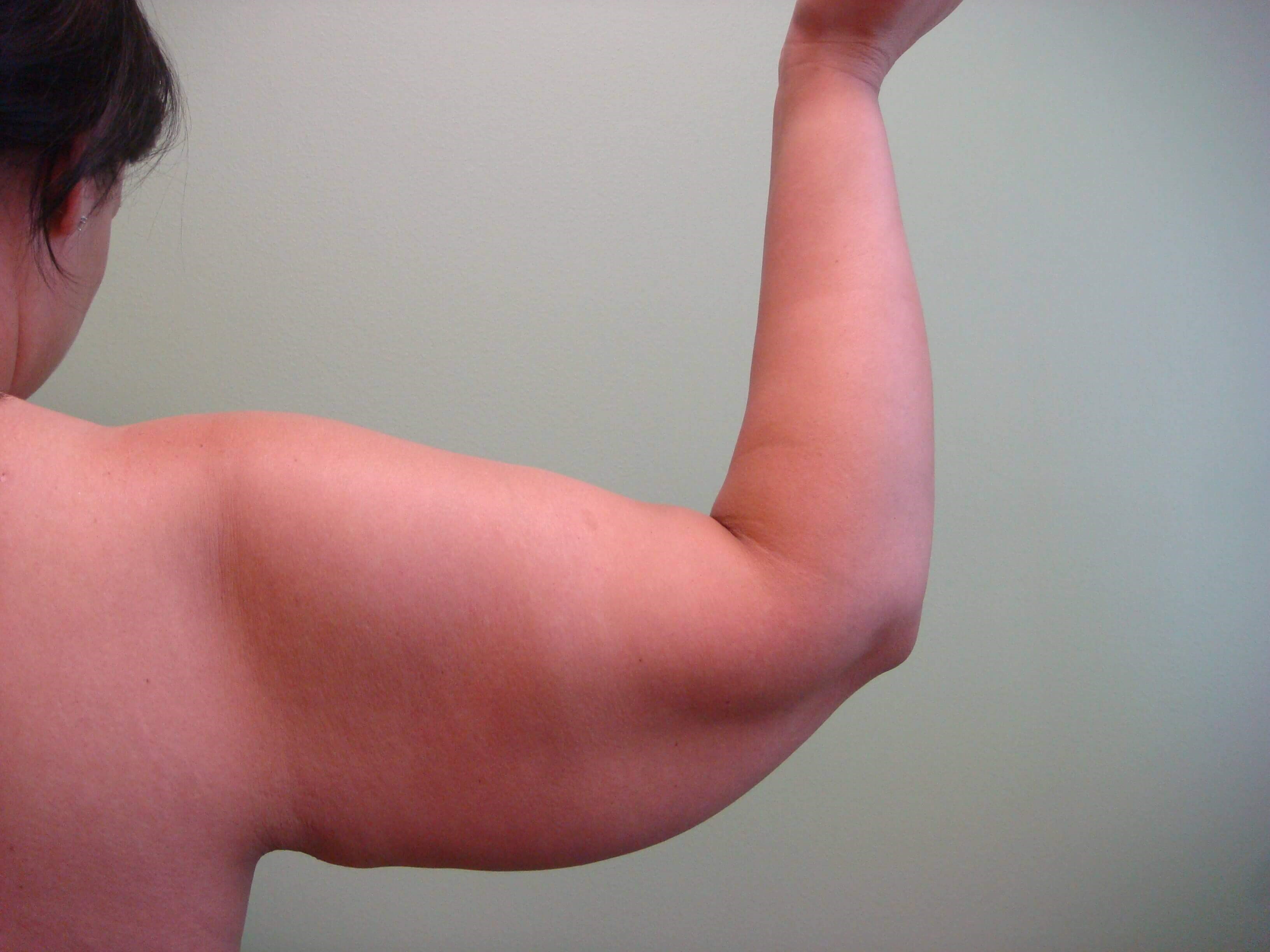 Brachioplasty (Arm Lift) Before